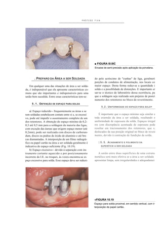 PRÓTESE   FIXA




                                                             ■ FIGURA I0.I8C
                                                             Encaixe de semi-precisão após aplicação da porcelana.



        . PREPARO DA ÁREA A SER SOLDADA                      do pelo acréscimo de "cunhas" de liga, geralmeri
                                                             porções de condutos de alimentação, nos locais co
    Em qualquer uma das situações de área a ser solda-       maior espaço. Desta forma reduz-se a quantidade i
da, é indispensável que ela apresente características co-    solda e a possiblidade de distorções. E importante ai
muns que são importantes e indispensáveis para uma           sar-se o técnico de laboratório dessa ocorrência, pa
união bem sucedida. Entre essas características tem-se:      que a soldagem seja realizada sem prejuízo de posici
                                                             namento dos retentores no bloco de revestimento.
     5 . 1 . O BTENÇÃO   DE ESPAÇO PARA SOLDA
                                                                    5 . 2 . U NIFORMIDADE   DO ESPAÇO PARA SOLD >

    a) Espaço reduzido - frequentemente as áreas a se
rem soldadas estabelecem contato entre si e, se excessi         É importante que o espaço mínimo seja similar e
vo, pode até impedir o assentamento completo de um           toda extensão da área a ser soldada, resultando e
dos retentores. A obtenção de espaço mínimo de 0,2-          uniformidade de espessura da solda. Espaços irregul
0,3 até 0,5 mm para a soldagem da maioria das ligas,         res com discrepância acentuada de espessura pode
com exceção das áureas que exigem espaço menor (até          resultar em tracionamento dos retentores, que s;
0,2mm), pode ser realizada com discos de carborun-           deslocados da sua posição original no bloco de revesi
dum, discos ou pedras de óxido de alumínio e até bro         mento, devido à contração de fundição da solda.
cas diamantadas. A interposição de um filme radiográ-
fico ou papel cartão na área a ser soldada geralmente é         | 5 . 5 . A CABAMENTO   E POLIMENTO DA

indicativa de espaço suficiente (Fig. 10.19).                       SUPERFÍCIE A SER SOLDADA

    b) Espaço excessivo - devido à separação com ins
trumento cortante aquecido e por posicionamento                 A união entre duas superfícies de uma estrutu
incorreto da I.E. no troquei, às vezes encontra-se es        metálica será mais efetiva se a área a ser soldada
paço excessivo para solda. Esse espaço deve ser reduzi-      apresentar limpa, sem irregularidades e adequadamei




                                                             «FIGURA 10.19
                                                             Espaço para solda proximal, em sentido vertical, com ir
                                                             terposição de papel cartão.
 