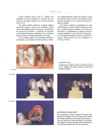 PRÓTESE   FIXA



                           Nessas situações tem se uma I.E. soldada com          em comprometimento estético por reduzir a espes
                        adaptação cervical satisfatória na maioria dos ele-      do material estético no local, está indicado um pr
                        mentos e um degrau negativo em um dos retentores         dimento de reparo na I.E., através de técnica de :
                        (Fig. 10.27).                                            dição secundária.
                           Em outras ocasiões percebe-se o degrau negativo           Esta técnica consiste na preparação do meta
                        acentuado durante a prova dos retentores, porém          infra-estrutura no local da falha, afinando-se suas
                        tem-se quantidade grande de pônticos fazendo parte       das e criando retenções mecânicas com discos de
                        da mesma peça fundida e a repetição do elemento          borundum e completando-se o término cervical i
                        com desajuste marginal juntamente com os pônticos        cera para fundição ou resina Duralay. Esse passo r.
                        poderia resultar em perda significativa de tempo.        ser executado diretamente na boca ou através de r
                           Se este degrau negativo for acentuado, grosseiro e    troquei obtido através de nova moldagem. (I
                        discrepante, cujo desgaste dentário poderia resultar     10.28Aa 10.28C)




>•:■                                                                               ■ FIGURA 10.27
                                                                                   Visualização de degrau positivo vestibular durante p
                                                                                   da I.E. soldada; esta falha ocorreu por fratura da <
           FIG. 10.27
                                                                                   metálica vestibular


       FIG. I0.28A




       FIG. I0.28C




                                                                                 ■ FIGURAS IO.28Aa I0.28C
                                                                                 (A) Visualização do degrau negativo no troquei, após
                                                                                 petição da moldagem, que será utilizado para refund
                                                                                 das margens deficientes; (B) preparo das margens <
                                                                                 disco de caborundum para refundição; (C) reconstitu
                                                                                 das margens com resina Duralay; esse procedimento p
                                                                                 ser executado diretamente na boca do paciente.
 