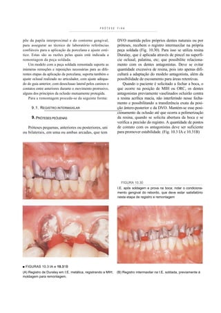 PRÓTESE   FI XA



põe da papila interproximal e do contorno gengival,            DVO mantida pelos próprios dentes naturais ou por
para assegurar ao técnico de laboratório referências           próteses, recebem o registro intermaxilar na própria
confiáveis para a aplicação da porcelana e ajuste esté-        peça soldada (Fig. 10.30). Para isso se utiliza resina
tico. Estas são as razões pelas quais está indicada a          Duralay, que é aplicada através de pincel na superfí-
remontagem da peça soldada.                                    cie oclusal, palatina, etc; que possibilite relaciona-
    Um modelo com a peça soldada remontada suporta as          mento com os dentes antagonistas. Deve se evitar
inúmeras remoções e reposições necessárias para as dife-       quantidade excessiva de resina, pois isto apenas difi-
rentes etapas da aplicação da porcelana; suporta também o      cultará a adaptação do modelo antagonista, além da
ajuste oclusal realizado no articulador, com ajuste adequa-    possibilidade de escoamento para áreas retentivas.
do do guia anterior, com desoclusao lateral pelos caninos e       Quando o paciente é solicitado a fechar a boca, o
contatos entre anteriores durante o movimento protrusivo,      que ocorre na posição de MIH ou ORC, os dentes
alguns dos princípios da oclusão mutuamente protegida.         antagonistas previamente vaselinados ocluirão contra
    Para a remontagem procede-se da seguinte forma:            a resina acrílica macia, não interferindo nesse fecha-
                                                               mento e possibilitando a transferência exata da posi-
      9.1. REGISTRO INTERMAXILAR                               ção ântero-posterior e da DVO. Mantém-se esse posi-
                                                               cionamento da oclusão até que ocorra a polimerização
      9. PRÓTESES PEÓUENAS                                     da resina, quando se solicita abertura da boca e se
                                                               verifica a precisão do registro. A quantidade de pontos
   Próteses pequenas, anteriores ou posteriores, uni           de contato com os antagonistas deve ser suficiente
ou bilaterais, em uma ou ambas arcadas, que tem                para promover estabilidade. (Fig. 10.3 IA e 10.31B)




                                                                 FIGURA 10.30
                                                               I.E. após soldagem e prova na boca; notar o condiciona-
                                                               mento gengival do rebordo, que deve estar satisfatório
                                                               nesta etapa de registro e remontagem




■ FIGURAS 10.3 IA e 10.31B
(A) Registro de Duralay em I.E. metálica, registrando a MIH;   (B) Registro intermaxilar na I.E. soldada, previamente à
moldagem para remontagem.
 