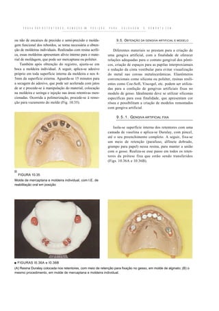 P R O V A D O S R E T E N T O R E S ,   R E M O Ç Ã O   EM   P O S I Ç Ã O   P A R A      S O L D A G E M   E   R E M O N T A C E M



ou não de encaixes de precisão e semi-precisão e molda-                                      9.5. OBTENÇÃO DA GENGIVA ARTIFICIAL E MODELO
gem funcional dos rebordos, se torna necessária a obten-
ção de moldeiras individuais. Realizadas com resina acríli-                            Diferentes materiais se prestam para a criação de
ca, essas moldeiras apresentam alívio interno para o mate-                         uma gengiva artificial, com a finalidade de oferecer
rial de moldagem, que pode ser mercaptana ou poliéter.                             relações adequadas para o contato gengival dos pônti-
    Também após obtenção do registro, ajusta-se em                                 cos, criação de espaços para as papilas interproxiamais
boca a moldeira individual. A seguir, aplica-se adesivo                            e redução da cinta vestibular para evitar visualização
próprio em toda superfície interna da moldeira e nos 4-                            do metal nas coroas metalocerâmicas. Elastômeros
5mm da superfície externa. Aguarda-se 15 minutos para                              convencionais como silicona ou poliéter, resinas resili-
a secagem do adesivo, que pode ser acelerada com jatos                             entes como Coe-Soft, Viscogel, etc. podem ser utiliza-
de ar e procede-se à manipulação do material, colocação                            das para a confeção de gengivas artificiais fixas no
na moldeira e seringa e injeção nas áreas retentivas men-                          modelo de gesso. Idealmente deve se utilizar siliconas
cionadas. Ocorrida a polimerização, procede-se à remo-                             específicas para essa finalidade, que apresentam cor
ção para vazamento do molde (Fig. 10.35).                                          rósea e possibilitam a criação de modelos remontados
                                                                                   com gengiva artificial.

                                                                                             9 . 5 . 1 . GENGIVA ARTIFICIAL FIXA

                                                                                      Isola-se superfície interna dos retentores com uma
                                                                                   camada de vaselina e aplica-se Duralay, com pincel,
                                                                                   até o seu preenchimento completo. A seguir, fixa-se
                                                                                   um meio de retenção (parafuso, alfinete dobrado,
                                                                                   grampo para papel) nessa resina, para manter a união
                                                                                   com o gesso. Realiza-se esse passo em todos os reten-
                                                                                   tores da prótese fixa que estão sendo transferidos
                                                                                   (Figs. 10.36A e 10.36B).


  FIGURA 10.35
Molde de mercaptana e moldeira individual, com I.E. de
reabilitação oral em posição




■ FIGURAS I0.36A e I0.36B
(A) Resina Duralay colocada nos retentores, com meio de retenção para fixação no gesso, em molde de alginato; (B) o
mesmo procedimento, em molde de mercaptana e moldeira individual.
 
