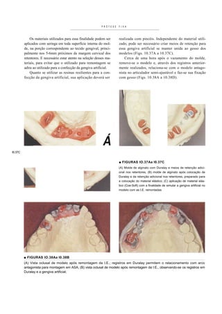 PRÓTESE   F I XA



             Os materiais utilizados para essa finalidade podem ser    realizada com pincéis. Independente do material utili-
         aplicados com seringa em toda superfície interna do mol-      zado, pode ser necessário criar meios de retenção para
         de, na porção correspondente ao tecido gengival, princi-      essa gengiva artificial se manter unida ao gesso dos
         palmente nos 5-6mm próximos da margem cervical dos            modelos (Figs. 10.37A a 10.37C).
         retentores. E necessário estar atento na seleção desses ma-       Cerca de uma hora após o vazamento do molde,
         teriais, para evitar que o utilizado para remontagem se       remove-se o modelo e, através dos registros anterior-
         adira ao utilizado para a confecção da gengiva artificial.    mente realizados, relaciona-se com o modelo antago-
             Quanto se utilizar as resinas resilientes para a con-     nista no articulador semi-ajustável e faz-se sua fixação
         fecção da gengiva artificial, sua aplicação deverá ser        com gesso (Figs. 10.38A a 10.38D).




                                                              Á
I0.37C


                                                                       ■ FIGURAS IO.37Aa I0.37C
                                                                       (A) Molde de alginato com Duralay e meios de retenção adici-
                                                                       onal nos retentores, (B) molde de alginato após colocação de
                                                                       Duralay e da retenção adicional nos retentores, preparado para
                                                                       a colocação do material elástico; (C) aplicação de material elás-
                                                                       tico (Coe-Soft) com a finalidade de simular a gengiva artificial no
                                                                       modelo com as I.E. remontadas




         ■ FIGURAS IO.38Aa I0.38B
         (A) Vista oclusal de modelo após remontagem da I.E.; registros em Duralay permitem o relacionamento com arco
         antagonista para montagem em ASA; (B) vista oclusal de modelo após remontagem da I.E., observando-se os registros em
         Duralay e a gengiva artificial;
 