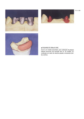 FIG. I0.39B




■ FIGURAS IO.39Aa I0.39C
(A) I.E. em modelo remontado, para confecção de gengiva
artificial removível; (B) remoção das I.E. do modelo; (C)
confecção de matriz de silicona pesada, envolvendo den-
tes vrzinhos.
 