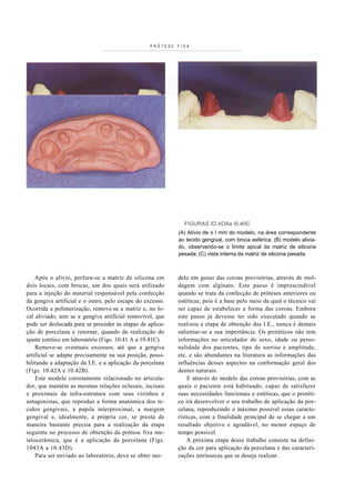 PRÓTESE FIXA




                                                             FIGURAS IO.4OAa I0.40C
                                                           (A) Alívio de ± I mm do modelo, na área correspondente
                                                           ao tecido gengival, com broca esférica; (B) modelo alivia-
                                                           do, observando-se o limite apical da matriz de silicona
                                                           pesada; (C) vista interna da matriz de silicona pesada.



    Após o alívio, perfura-se a matriz de silicona em      delo em gesso das coroas provisórias, através de mol-
dois locais, com brocas, um dos quais será utilizado       dagem com alginato. Este passo é imprescindível
para a injeção do material responsável pela confecção      quando se trata da confecção de próteses anteriores ou
da gengiva artificial e o outro, pelo escape do excesso.   estéticas, pois é a base pelo meio da qual o técnico vai
Ocorrida a polimerização, remove-se a matriz e, no lo-     ser capaz de estabelecer a forma das coroas. Embora
cal aliviado, tem se a gengiva artificial removível, que   este passo já devesse ter sido executado quando se
pode ser deslocada para se proceder às etapas de aplica-   realizou a etapa de obtenção das I.E., nunca é demais
ção de porcelana e retornar, quando da realização do       salientar-se a sua importância. Os protéticos não tem
ajuste estético em laboratório (Figs. 10.41 A a 10.41C).   informações no articulador do sexo, idade ou perso-
    Remove-se eventuais excessos, até que a gengiva        nalidade dos pacientes, tipo de sorriso e amplitude,
artificial se adapte precisamente na sua posição, possi-   etc, e são abundantes na literatura as informações das
bilitando a adaptação da I.E. e a aplicação da porcelana   influências desses aspectos na conformação geral dos
(Figs. 10.42A e 10.42B).                                   dentes naturais.
    Este modelo corretamente relacionado no articula-          E através do modelo das coroas provisórias, com as
dor, que mantém as mesmas relações oclusais, incisais      quais o paciente está habituado, capaz de satisfazer
e proximais da infra-estrutura com seus vizinhos e         suas necessidades funcionais e estéticas, que o protéti-
antagonistas, que reproduz a forma anatómica dos te-       co irá desenvolver o seu trabalho de aplicação da por-
cidos gengivais, a papila interproximal, a margem          celana, reproduzindo o máximo possível essas caracte-
gengival e, idealmente, a própria cor, se presta de        rísticas, com a finalidade principal de se chegar a um
maneira bastante precisa para a realização da etapa        resultado objetivo e agradável, no menor espaço de
seguinte no processo de obtenção da prótese fixa me-       tempo possível.
talocerâmica, que é a aplicação da porcelana (Figs.            A próxima etapa desse trabalho consiste na defini-
1043A a 10.43D).                                           ção da cor para aplicação da porcelana e das caracteri-
    Para ser enviado ao laboratório, deve se obter mo-     zações intrínsecas que se deseja realizar.
 