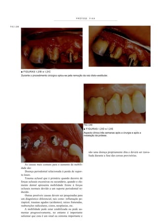 PRÓTESE       FIXA



FIG I.2IB




            ■ FIGURAS I.2IB e I.2IC
            Durante o procedimento cirúrgico optou-se pela remoção da raiz disto-vestibular.




                                                                       FIG I.2ID
                                                                       ■ FIGURAS I.2ID e I.2IE
                                                                       Aspecto clínico três semanas após a cirurgia e após a
                                                                       instalação da prótese.




                                                                            não uma doença propriamente dita e deverá ser reava-
                                                                            liada durante a fase das coroas provisórias.


                As causas mais comuns para o aumento de mobili-
            dade são:
                Doença periodontal relacionada à perda de supor-
            te ósseo.
                Trauma oclusal que é primário quando decorre de
            forças oclusais excessivas ou secundário, quando o ele-
            mento dental apresenta mobilidade frente à forças
            oclusais normais devido a um suporte periodontal re-
            duzido.
                Outras possíveis causas devem ser pesquisadas para
            um diagnóstico diferencial, tais como: inflamação pe-
            riapical, traumas agudos (acidentes), raízes fraturadas,
            reabsorções radiculares, cistos, neoplasias, etc.
                A mobilidade pode estar estabilizada ou pode au-
            mentar progressivamente, no entanto é importante
            salientar que esta é um sinal ou sintoma importante e
 