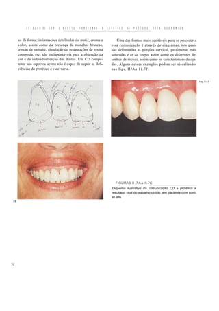 S E L E Ç Ã O   DE   C O R   E   A J U S T E   F U N C I O N A L   E   E S T É T I C O   EM   P R Ó T E S E   M E T A L O C E R Â M I C A



      so da forma; informações detalhadas do matiz, croma e                               Uma das formas mais aceitáveis para se proceder a
      valor, assim como da presença de manchas brancas,                               essa comunicação é através de diagramas, nos quais
      trincas de esmalte, simulação de restaurações de resina                         são delimitadas as porções cervical, geralmente mais
      composta, etc, são indispensáveis para a obtenção da                            saturadas e as de corpo, assim como os diferentes de-
      cor e da individualização dos dentes. Um CD compe-                              senhos da incisai, assim como as características deseja-
      tente nos aspectos acima não é capaz de suprir as defi-                         das. Alguns desses exemplos podem ser visualizados
      ciências do protético e vice-versa.                                             nas figs. HJAa 11.7F.


                                                                                                                                                       FIG 1 1 . 7




                                                                                          FIGURAS l l . 7 A a II.7C
                                                                                      Esquema ilustrativo da comunicação CD x protético e
                                                                                      resultado final do trabalho obtido, em paciente com sorri-
                                                                                      so alto.
.7A




7C
 
