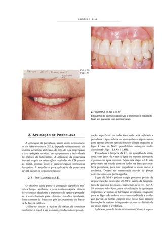 PRÓTESE        EIXA




                                                   FIG II.7D
                                                   FIG I I.7F




                                                                ■ FIGURAS II.7D a II.7F
                                                                Esquema de comunicação CD x protético e resultado
                                                                final, em paciente com sorriso baixo.




     2. A PLICA ÇÃO       DE   P ORCELA NA                      zação superficial em toda área onde será aplicada a
                                                                porcelana. Ligas nobres ou semi-nobres exigem usina-
    A aplicação de porcelana, assim como o tratamen-            gem apenas em um sentido (mésio-distal) enquanto as
to da infra-estrutura (I.E.), depende sobremaneira do           ligas à base de Ni-Cr possibilitam usinagem multi-
sistema cerâmico utilizado, do tipo de liga empregado           direcional (Figs 11.8Ae 11.8B).
e das variações técnicas, de equipamento e individuais              Procede-se à limpeza da I.E. em aparelho de ultra-
do técnico de laboratório. A aplicação da porcelana             som, com jatos de vapor d'água ou mesmo escovaçáo
buscará seguir as orientações recebidas do CD quanto            vigorosa em água corrente. Após esta etapa, a I.E. não
ao matiz, croma, valor e caracterizações intrínsecas            pode mais ser tocada com os dedos na área que rece-
desejadas. A sequência para aplicação da porcelana              berá porcelana, para não prejudicar a união metal x
deverá seguir os seguintes passos:                              cerâmica. Deverá ser manuseada através de pinças
                                                                convencionais ou porta-agulha.
     2 .1 . TRATAMENTO DA I.E.                                      Ligas de Ni-Cr podem exigir processo prévio de
                                                                degaseificação, realizado 20-30°C acima da tempera-
    O objetivo deste passo é conseguir superfície me-           tura de queima do opaco, mantendo-se a I.E. por 5-
tálica limpa, uniforme e sem contaminações, obten-              10 minutos sob vácuo, para volatilização de quaisquer
do-se espaço ideal para a espessura de opaco e porcela-         impurezas, evitando-se formação de óxidos. Enquanto
na e contribuindo para eliminar tensões residuais,              para as ligas não nobres está contra-indicada a oxida-
fonte comum de fracassos por deslocamento ou fratu-             ção prévia, as nobres exigem esse passo para garantir
ra da faceta estética.                                          formação de óxidos indispensáveis para a efetividade
    Utiliza-se discos e pedras de óxido de alumínio             da união metal x cerâmica.
conforme o local a ser usinado, produzindo regulari-                Aplica-se jatos de óxido de alumínio (50um) à super-
 