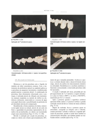 RÓTESE   FIXA




■ FIGURA I I . I O A                                            FIGURA II.IOB
              a
Aplicação da I camada de opaco.                               Caracterização intrínseca sobre o opaco, na região cer-
                                                              vical.




  FIGURA II.IOC                                               ■ FIGURA II.IOD
Caracterização intrínseca sobre o opaco, na superfície        Aplicação da 2a camada de opaco.
oclusal.


      2.5. A PLICAÇÃO DE PORCELANA                            maior do que o tamanho pretendido. Avalia-se e ajus-
                                                              ta-se a oclusão durante todo o desenvolvimento dessa
    Mistura-se o pó da porcelana com o líquido de             etapa, através da análise do relacionamento dentário
modelar até obter consistência cremosa. Com o ins-            no articulador. Restabelece-se a escultura anatómica e
trumento de preferência (pincel ou espátula) aplica-se        funcional, acrescentando e removendo porcelana onde
a porcelana em pequenos incrementos, restabelecendo           for necessário.
gradativamente a anatomia dental. A condensação da                A cocção é realizada sob vácuo, precedida por um
porcelana, fator diretamente relacionado com a con-           pré-aquecimento de 3 a 5 minutos; a seguir introduz-
traçao, é realizada através da vibração com instrumen-        se a peça no forno a 600°C e se eleva a 920-930°C,
tos manuais (espátulas ou martelo de chifre) ou ele-          mantendo por 0,5 a 1 minuto.
trônicos (ultrasom), removendo-se o excesso de água               Após a primeira queima a superfície cerâmica
com papel absorvente e possibilitando às partículas de        apresenta brilho sedoso e é possível verificar a grande
pó densidade máxima de compactação.                           contração inicial devido ao volume da massa cerâmica
    Restabelecida a forma anatómica do dente, remove-         (Fig. 11.12).
se da região incisai ou oclusal, através de um corte em           Depois de resfriada, faz-se o primeiro ajuste no
bisel, a quantidade de porcelana representativa do es-        articulador, corrigindo as relações com o rebordo,
malte e da sua tanslucidez, se o dente a ser reconstruído     contato proximal e oclusão e realiza-se a segunda apli-
exigir essas características (Figs. l l . l l A e 11.11B).    cação de porcelana, quando se pode fazer também as
    Devido à contração por cocção da porcelana, es-           caracterizações desejadas, que também podem ser rea-
culpe-se o dente com volume aproximadamente 20%               lizadas desde a camada opaca (Fig. 11.13).
 