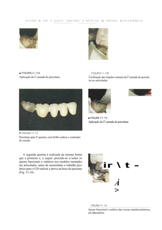 S E L E Ç Ã O   DE   C O R   E   A J U S T E   F U N C I O N A I   E   E S T É T I C O   EM   P R Ó T E S E   M E T A L O C E R Â M I C A




■ FIGURA I I . I I A                                                               FIGURA I I . I I B
                  a
Aplicação da I camada de porcelana.                                            Verificação das relações oclusais da Ia camada de porcela-
                                                                               na no articulador




                                                                               ■ FIGURA 11. 13
                                                                               Aplicação da 2a camada de porcelana.


  FIGURA 11.12
Porcelana após Ia queima, com brilho sedoso e contração
de cocção.




    A segunda queima é realizada da mesma forma
que a primeira e, a seguir, procede-se a todos os
ajustes funcionais e estéticos nos modelos montados
em articulador, antes de encaminhar o trabalho pro-
tético para o CD realizar a prova na boca do paciente
                                                                                                ir  t -
(Fig. 11.14).



                                                                                                              À
                                                                                                              >
                                                                                  FIGURA 11.14
                                                                               Ajuste funcional e estético das coroas metalocerâmicas,
                                                                               em laboratório.
 