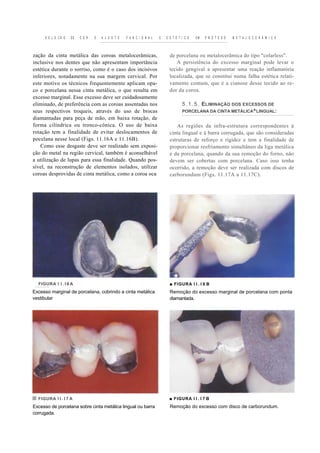 S E L E CÃ O   DE   C O R   E   A J U S T E   F U N C I O N A L   E   E S T É T I C O   EM   P R Ó T E S E   M E T A L O C E R Â M I C A



zação da cinta metálica das coroas metalocerâmicas,                          de porcelana ou metalocerâmica do tipo "colarless".
inclusive nos dentes que não apresentam importância                             A persistência do excesso marginal pode levar o
estética durante o sorriso, como é o caso dos incisivos                      tecido gengival a apresentar uma reação inflamatória
inferiores, notadamente na sua margem cervical. Por                          localizada, que se constitui numa falha estética relati-
este motivo os técnicos frequentemente aplicam opa-                          vamente comum, que é a cianose desse tecido ao re-
co e porcelana nessa cinta metálica, o que resulta em                        dor da coroa.
excesso marginal. Esse excesso deve ser cuidadosamente
eliminado, de preferência com as coroas assentadas nos                               5 . 1 . 5 . ELIMINAÇÃO DOS EXCESSOS DE
seus respectivos troqueis, através do uso de brocas                                  PORCELANA DA CINTA METÁLICA^LINGUAL:
diamantadas para peça de mão, em baixa rotação, de
forma cilíndrica ou tronco-cônica. O uso de baixa                                As regiões da infra-estrutura correspondentes à
rotação tem a finalidade de evitar deslocamentos de                          cinta lingual e à barra corrugada, que são consideradas
pocelana nesse local (Figs. 11.16A e 11.16B).                                estruturas de reforço e rigidez e tem a finalidade de
    Como esse desgaste deve ser realizado sem exposi-                        proporcionar resfriamento simultâneo da liga metálica
ção do metal na região cervical, também é aconselhável                       e da porcelana, quando da sua remoção do forno, não
a utilização de lupas para essa finalidade. Quando pos-                      devem ser cobertas com porcelana. Caso isso tenha
sível, na reconstrução de elementos isolados, utilizar                       ocorrido, a remoção deve ser realizada com discos de
coroas desprovidas de cinta metálica, como a coroa oca                       carborundum (Figs. 11.17A a 11.17C).




  FIGURA I I . I 6 A                                                         ■ FIGURA I I . I 6 B
Excesso marginal de porcelana, cobrindo a cinta metálica                     Remoção do excesso marginal de porcelana com ponta
vestibular                                                                   diamantada.




  FIGURA I I . I 7 A                                                        ■ FIGURA I I . I 7 B
Excesso de porcelana sobre cinta metálica lingual ou barra                   Remoção do excesso com disco de carborundum.
corrugada.
 