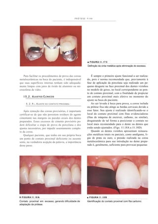 PRÓTESE   FIXA




                                                                ■ FIGUR A I I . I 7 C
                                                                Definição da cinta metálica após eliminação do excesso.



   Para facilitar os procedimentos de prova das coroas              É sempre o primeiro ajuste funcional a ser realiza-
metalocerâmicas na boca do paciente, é indispensável            do, pois é norma recomendada que, previamente à
que suas superfícies internas tenham sido adequada-             fase de aplicação da porcelana seja realizado um pe-
mente limpas com jatos de óxido de alumínio ou mi-              queno desgaste na face proximal dos dentes vizinhos
croesferas de vidro.                                            no modelo de gesso, no local correspondente ao pon-
                                                                to de contato proximal, com a finalidade de propiciar
    I 5 . 2 . AJUSTES CLÍNICOS                                  um contato proximal mais efetivo no momento do
                                                                ajuste na boca do paciente.
      5 . 2 . 1 - . A JUSTE   DO CONTATO PROXIMAL :                 Ao ser levada à boca para prova, a coroa isolada
                                                                ou prótese fixa não atinge as bordas cervicais devido a
   Após remoção das coroas provisórias, é importante            esse fator. Seu ajuste é realizado identificando-se o
certificar-se de que não persistem resíduos do agente           local do contato proximal com fitas evidenciadoras
cimentante nas margens ou paredes axiais dos dentes             (fitas de máquina de escrever, carbono, ou similar),
preparados. Esses excessos de cimento provisório po-            desgastando de tal forma a posicionar o contato no
dem dificultar a etapa de prova da porcelana e dos              local mais recomendado para o dente ou dentes que
ajustes necessários, por impedir assentamento comple-           estão sendo ajustados. (Figs. 11.18A a 11.18D).
to da coroa.                                                        Quando os dentes vizinhos apresentam restaura-
    Qualquer paciente, que tenha em sua própria boca            ções metálicas totais ou parciais, como amálgama, li-
um ponto de contato proximal deficiente ou ausente              gas de prata ou ouro, a pressão realizada na coroa
sente, na verdadeira acepção da palavra, a importância          metalocerâmica para sua introdução no dente prepa-
desse passo.                                                    rado é, geralmente, suficiente para provocar pequenas




H FIGURA I I . I 8 A                                            ■ FIGURA I I . I 8 B
Contato proximal em excesso, gerando dificuldade de             Identificação do contato proximal com fita carbono.
adaptação da prótese.
 