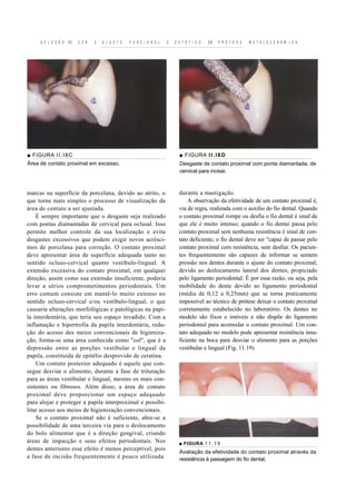 S E L E Ç Ã O   DE   C O R   E   A J U S T E   F U N C I O N A L   E   E S T É T I C O   EM   P R Ó T E S E   M E T A L O C E R Â M I C A




■ FIGURA I I . I 8 C                                                           ■ FIGURA I I . I 8 D
Área de contato proximal em excesso.                                           Desgaste de contato proximal com ponta diamantada, de
                                                                               cervical para incisai.



marcas na superfície da porcelana, devido ao atrito, o                         durante a mastigação.
que torna mais simples o processo de visualização da                               A observação da efetividade de um contato proximal é,
área de contato a ser ajustada.                                                via de regra, realizada com o auxílio do fio dental. Quando
    É sempre importante que o desgaste seja realizado                          o contato proximal rompe ou desfia o fio dental é sinal de
com pontas diamantadas de cervical para oclusal. Isso                          que ele é muito intenso; quando o fio dentai passa pelo
permite melhor controle da sua localização e evita                             contato proximal sem nenhuma resistência é sinal de con-
desgastes excessivos que podem exigir novos acrésci-                           tato deficiente; o fio dental deve ser "capaz de passar pelo
mos de porcelana para correção. O contato proximal                             contato proximal com resistência, sem desfiar. Os pacien-
deve apresentar área de superfície adequada tanto no                           tes frequentemente são capazes de informar se sentem
sentido ocluso-cervical quanto vestibulo-lingual. A                            pressão nos dentes durante o ajuste do contato proximal,
extensão excessiva do contato proximal, em qualquer                            devido ao deslocamento lateral dos dentes, propiciado
direção, assim como sua extensão insuficiente, poderia                         pelo ligamento periodontal. É por essa razão, ou seja, pela
levar a sérios comprometimentos periodontais. Um                               mobilidade do dente devido ao ligamento periodontal
erro comum consiste em mantê-lo muito extenso no                               (média de 0,12 a 0,25mm) que se torna praticamente
sentido ocluso-cervical e/ou vestibulo-lingual, o que                          impossível ao técnico de prótese deixar o contato proximal
causaria alterações morfológicas e patológicas na papi-                        corretamente estabelecido no laboratório. Os dentes no
la interdentária, que teria seu espaço invadido. Com a                         modelo são fixos e imóveis e não dispõe do ligamento
inflamação e hipertrofia da papila interdentária, redu-                        periodontal para acomodar o contato proximal. Um con-
ção do acesso dos meios convencionais de higieniza-                            tato adequado no modelo pode apresentar resistência insu-
ção, forma-se uma área conhecida como "col", que é a                           ficiente na boca para desviar o alimento para as porções
depressão entre as porções vestibular e lingual da                             vestibular e lingual (Fig. 11.19).
papila, constituída de epitélio desprovido de ceratina.
    Um contato posterior adequado é aquele que con-
segue desviar o alimento, durante a fase de trituração
para as áreas vestibular e lingual, mesmo os mais con-
sistentes ou fibrosos. Além disso, a área de contato
proximal deve proporcionar um espaço adequado
para alojar e proteger a papila interproximal e possibi-
litar acesso aos meios de higienização convencionais.
    Se o contato proximal não é suficiente, abre-se a
possibilidade de uma terceira via para o deslocamento
do bolo alimentar que é a direção gengival, criando
áreas de impacção e seus efeitos periodontais. Nos                             ■ FIGURA 1 1 . 1 9
dentes anteriores esse efeito é menos perceptível, pois
                                                                               Avaliação da efetividade do contato proximal através da
a fase de incisão frequentemente é pouco utilizada                             resistência à passagem do fio dental.
 