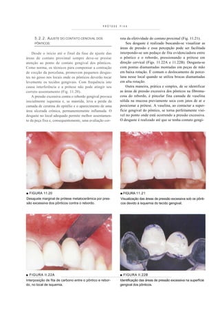 PRÓTESE   FIXA



     5 . 2 . 2 . AJUSTE DO CONTATO CENCIVAL DOS              reta da efetividade do contato proximal (Fig. 11.21).
     PÔNTICOS:                                                   Seu desgaste é realizado buscando-se visualizar as
                                                             áreas de pressão e essa percepção pode ser facilitada
    Desde o início até o final da fase de ajuste das         interpondo-se um pedaço de fita evidenciadora entre
áreas de contato proximal sempre deve-se prestar             o pôntico e o rebordo, pressionando a prótese em
atenção ao ponto de contato gengival dos pônticos.           direção cervical (Figs. 11.22A e 11.22B). Desgasta-se
Como norma, os técnicos para compensar a contração           com pontas diamantadas montadas em peças de mão
de cocção da porcelana, promovem pequenos desgas-            em baixa rotação. É comum o deslocamento de porce-
tes no gesso nos locais onde os pônticos deverão tocar       lana nesse local quando se utiliza brocas diamantadas
levemente os tecidos gengivais. Com frequência isto          em alta rotação.
causa interferência e a prótese não pode atingir seu             Outra maneira, prática e simples, de se identificar
correto assentamento (Fig. 11.20).                           as áreas de pressão excessiva dos pônticos na fibromu-
    A pressão excessiva contra o rebordo gengival provoca    cosa do rebordo, é pincelar fina camada de vaselina
inicialmente isquemia e, se mantida, leva a perda da         sólida na mucosa previamente seca com jatos de ar e
camada de ceratina do epitélio e o aparecimento de uma       posicionar a prótese. A vaselina, ao contactar a super-
área ulcerada crónica, permanentemente inflamada. O          fície gengival do pôntico, se torna perfeitamente visí-
desgaste no local adequado permite melhor assentamen-        vel no ponto onde está ocorrendo a pressão excessiva.
to da peça fixa e, consequentemente, uma avaliação cor-      O desgaste é realizado até que se tenha contato gengi-




■ FIGURA 11.20                                               ■ FIGURA 11.21
Desajuste marginal de prótese metalocerâmica por pres-       Visualização das áreas de pressão excessiva sob os pônti-
são excessiva dos pônticos contra o rebordo.                 cos devido à isquemia do tecido gengival.




■ FIGURA II.22A                                              ■ FIGURA II.22B
Interposição de fita de carbono entre o pôntico e rebor-     Identificação das áreas de pressão excessiva na superfície
do, no local de isquemia.                                    gengival dos pônticos.
 