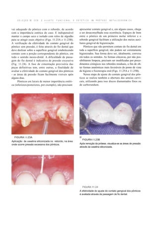 S E L E Ç Ã O   DE   C O R   E   A J U S T E   F U N C I O N A L   E   E S T É T I C O   EM   P R Ó T E S E   M E T A L O C E R Â M I C A



vai adequado do pôntico com o rebordo, de acordo                               apresentar contato gengival e, em alguns casos, chega
com a importância estética do caso. E indispensável                            a ser desaconselhada essa ocorrência. Espaços de lmm
manter o campo seco e isolado com rolos de algodão                             entre o pôntico de um primeiro molar inferior e o
para se atingir esses objetivo (Figs. 11.23A e 11.23B).                        rebordo gengival facilitam a utilização dos meios auxi-
A verificação da efetividade do contato gengival do                            liares gengival de higienização.
pôntico sem pressão, é feita através do fio dental que                             Pônticos que não permitem contato do fio dental em
deve deslizar sobre a superfície gengival estabelecendo                        toda a superfície gengival, não podem ser corretamente
contato com a porção correspondente do pôntico, em                             higienizados. Sua forma deve ser, idealmente, convexa
todo o sentido mesio-distal. A dificuldade de passa-                           em todos os sentidos. As formas côncavas, por não pos-
gem do fio dental é indicativa de pressão excessiva                            sibilitarem limpeza, precisam ser modificadas por proce-
(Fig. 11.24). A fase de cimentação provisória das                              dimentos cirúrgicos nos rebordos residuais, a fim de ob-
peças definitivas tem, entre outras, a finalidade de                           ter formas anatómicas mais favoráveis do ponto de vista
avaliar a efetividade do contato gengival dos pônticos                         da higiene e fisioterapia oral (Figs. 11.25A e 11.25B).
- as áreas de pressão ficam facilmente visíveis após                               Nessa etapa de ajuste do contato gengival dos pôn-
alguns dias.                                                                   ticos se realiza também a abertura das ameias cervi-
      Pônticos em locais de menor importância estéti-                          cais, utilizando para isso discos diamantados finos ou
ca (inferiores/posteriores, por exemplo), não precisam                         de carborundum.




  FIGURA I I.23A
                                                                                   FIGURA I I.23B
Aplicação de vaselina siliconizada no rebordo, na área
onde ocorre pressão excessiva dos pônticos.                                    Após remoção da prótese, visualiza-se as áreas de pressão
                                                                               através da vaselina siliconizada.




                                                                                   FIGURA 11.24
                                                                               A efetividade do ajuste do contato gengival dos pônticos
                                                                               é avaliada através da passagem de fio dental.
 