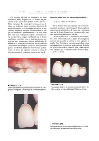 S E L E Ç Ã O   DE   C O R   E   A J U S T E   F U N C I O N A L   E   E S T É T I C O   EM   P R Ó T E S E   M E T A L O C E R Â M I C A



    Um cuidado adicional na observação de áreas                                  ficiências destas, mas sim, das coroas provisórias.
isquêmicas, tanto na prova da I.E. quanto da por-
celana, é que essas áreas podem ocorrer devido a                                         5 . 2 . 5 . 2 . PERFIL DE EMERGÊNCIA
falhas marginais das coroas provisórias, que não ti-
nham ou perderam, pelas remoções, limpezas de                                        Ao se eliminar áreas de isquemia, está-se simulta-
agente cimentante e recolocações sucessivas, a pre-                              neamente ajustando o próprio perfil de emergência
cisão da adaptação marginal obtida durante as eta-                               das coroas metalocerâmicas de modo que a porcelana
pas de confecção e reembasamento. Um bom meio                                    saia reta de dentro do sulco sem exercer pressões late-
para fazer essa avaliação é adaptar a coroa provisó-                             rais, intoleráveis pelo epitélio sulcular.
ria no respectivo troquei, verificando se os locais                                  Um meio prático de se determinar precisamen-
isquêmicos coincidem com as áreas das coroas pro-                                te a área relacionada com o perfil de emergência
visórias que apresentam alguma deficiência de                                    consiste em assentar a prótese e, com lapiseira e
adaptação. Coroas provisórias que não se adaptam                                 grafite fino, delimitar a margem gengival da coroa
corretamente nas margens cervicais, principalmente                               metalocerâmica. O desgaste será realizado da linha
quando ocorre falta de resina, promovem o apareci-                               de grafite em direção cervical, pois é exatamente
mento de áreas de isquemia durante a prova de                                    esta a região que se localiza dentro do sulco (Figs.
infra-estrutura e da porcelana, mas que não são de-                              11.27A a 11.27C).




■ FIGURA I I . 2 7 A                                                             ■ FIGURA II.27B

Delimitação da área de porcelana colocada dentro do sulco                        Visualização da área de porcelana colocada dentro do
gengival, com grafite, para correção do perfil de emergência.                    sulco gengival para correção do perfil de emergência.




                                                                                 ■ FIGURA I I . 27C
                                                                                 Desgaste da área de porcelana relacionada com o perfil
                                                                                 de emergência, através de pontas diamantadas.
 