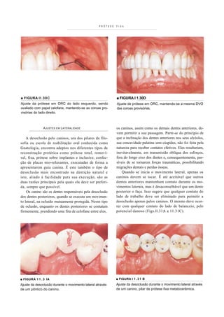 PRÓTESE   F I XA




■ FIGURA I I . 3 0 C                                         ■ FIGURA I 1.30D
Ajuste da prótese em ORC do lado esquerdo, sendo             Ajuste de prótese em ORC, mantendo-se a mesma DVO
avaliado com papel celofane, mantendo-se as coroas pro-      das coroas provisórias.
visórias do lado direito.



               A JUSTES EM L ATERALIDADE                     os caninos, assim como os demais dentes anteriores, de-
                                                             vem permitir a sua passagem. Parte-se do princípio de
    A desoclusão pelo caninos, ura dos pilares da filo-      que a inclinação dos dentes anteriores nos seus alvéolos,
sofia ou escola de reabilitação oral conhecida como          sua concavidade palatina sem cúspides, não foi feita pela
Gnatologia, encontra adeptos nos diferentes tipos de         natureza para receber contatos efetivos. Eles resultariam,
reconstrução protética como prótese total, removí-           inevitavelmente, em transmissão oblíqua dos esforços,
vel, fixa, prótese sobre implantes e inclusive, confec-      fora do longo eixo dos dentes e, consequentemente, pas-
ção de placas mio-relaxantes, executadas de forma a          síveis de se tornarem forças traumáticas, possibilitando
apresentarem guia canina. É este também o tipo de            migrações dentais e perdas ósseas.
desoclusão mais encontrado na dentição natural e                 Quando se inicia o movimento lateral, apenas os
isto, aliado à facilidade para sua execução, são as          caninos devem se tocar. É até aceitável que outros
duas razões principais pela quais ela deve ser preferi-      dentes anteriores mantenham contato durante os mo-
da, sempre que possível.                                     vimentos laterais, mas é desaconselhável que um dente
    Os canino são os dentes responsáveis pela desoclusão     posterior o faça. Isso sugere que qualquer contato do
dos dentes posteriores, quando se executa um movimen-        lado de trabalho deve ser eliminado para permitir a
to lateral, na oclusão mutuamente protegida. Nesse tipo      desoclusão apenas pelos caninos. O mesmo deve ocor-
de oclusão, enquanto os dentes posteriores se contatam       rer com qualquer contato do lado de balanceio, pelo
firmemente, prendendo uma fita de celofane entre eles,       potencial danoso (Figs.ll.31A a 11.31C).




■ FIGURA 1 1 . 3 IA                                          ■ FIGURA I 1 . 3 1 B
Ajuste da desoclusão durante o movimento lateral através     Ajuste da desoclusão durante o movimento lateral através
de um pôntico do canino.                                     de um canino, pilar de prótese fixa metalocerâmica.
 