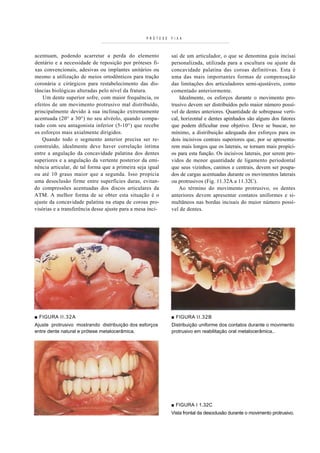 PRÓTESE   F I XA



acentuam, podendo acarretar a perda do elemento              sai de um articulador, o que se denomina guia incisai
dentário e a necessidade de reposição por próteses fi-       personalizada, utilizada para a escultura ou ajuste da
xas convencionais, adesivas ou implantes unitários ou        concavidade palatina das coroas definitivas. Esta é
mesmo a utilização de meios ortodônticos para tração         uma das mais importantes formas de compensação
coronária e cirúrgicos para restabelecimento das dis-        das limitações dos articuladores semi-ajustáveis, como
tâncias biológicas alteradas pelo nível da fratura.          comentado anteriormente.
    Um dente superior sofre, com maior frequência, os            Idealmente, os esforços durante o movimento pro-
efeitos de um movimento protrusivo mal distribuído,          trusivo devem ser distribuídos pelo maior número possí-
principalmente devido à sua inclinação extremamente          vel de dentes anteriores. Quantidade de sobrepasse verti-
acentuada (20° a 30°) no seu alvéolo, quando compa-          cal, horizontal e dentes apinhados são alguns dos fatores
rado com seu antagonista inferior (5-10°) que recebe         que podem dificultar esse objetivo. Deve se buscar, no
os esforços mais axialmente dirigidos.                       mínimo, a distribuição adequada dos esforços para os
   Quando todo o segmento anterior precisa ser re-           dois incisivos centrais superiores que, por se apresenta-
construído, idealmente deve haver correlação íntima          rem mais longos que os laterais, se tornam mais propíci-
entre a angulação da concavidade palatina dos dentes         os para esta função. Os incisivos laterais, por serem pro-
superiores e a angulação da vertente posterior da emi-       vidos de menor quantidade de ligamento periodontal
nência articular, de tal forma que a primeira seja igual     que seus vizinhos, caninos e centrais, devem ser poupa-
ou até 10 graus maior que a segunda. Isso propicia           dos de cargas acentuadas durante os movimentos laterais
uma desoclusão firme entre superfícies duras, evitan-        ou protrusivos (Fig. 11.32A a 11.32C).
do compressões acentuadas dos discos articulares da              Ao término do movimento protrusivo, os dentes
ATM. A melhor forma de se obter esta situação é o            anteriores devem apresentar contatos uniformes e si-
ajuste da concavidade palatina na etapa de coroas pro-       multâneos nas bordas incisais do maior número possí-
visórias e a transferência desse ajuste para a mesa inci-    vel de dentes.




■ FIGURA I I . 3 2 A                                         ■ FIGURA II.32B
Ajuste protrusivo mostrando distribuição dos esforços        Distribuição uniforme dos contatos durante o movimento
entre dente natural e prótese metalocerâmica.                protrusivo em reabilitação oral metalocerâmica..




                                                             ■ FIGURA I 1.32C
                                                             Vista frontal da desoclusão durante o movimento protrusivo.
 