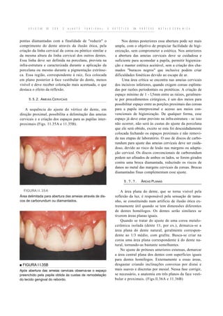 S E L E C AO   DE   C O R   E   A J U S T E   F U N C I O N A L   E   E S T É T I C O   EM   P R Ó T E S E   M E T A L O C E R A M I C A



pontas diamantadas com a finalidade de "reduzir" o                               Nos dentes posteriores essa abertura pode ser mais
comprimento do dente através da ilusão ótica, pela                           ampla, com o objetivo de propiciar facilidade de higi-
criação da linha cervical da coroa ou pôntico similar e                      enização, sem comprometer a estética. Nos anteriores
da mesma altura da linha cervical dos outros dentes.                         a abertura das ameias cervicais deve se cuidadosa e
Essa linha deve ser definida na porcelana, prevista na                       suficiente para acomodar a papila, permitir higieniza-
infra-estrutura e caracterizada durante a aplicação da                       ção e manter estética aceitável, sem a criação dos cha-
porcelana ou mesmo durante a pigmentação extrínse-                           mados "buracos negros" que inclusive podem criar
ca. Essa região, correspondente à raiz, fica colocada                        dificuldades fonéticas devido ao escape de ar.
em plano posterior à face vestibular do dente, menos                              Uma área crítica se encontra nas ameias cervicais
visível e deve receber coloração mais acentuada, o que                       dos incisivos inferiores, quando exigem coroas esplinta-
destaca o efeito da reflexão.                                                das por razões periodontais ou protéticas. A criação de
                                                                             espaço mínimo de 1 - l,5mm entre as raízes, geralmen-
     5 . 5 . 2 . AMEIAS CERVICAIS                                            te por procedimentos cirúrgicos, é um dos meios para
                                                                             possibilitar espaço entre as porções proximais das coroas
   A sequência do ajuste do vértice do dente, em                             para a papila interproximal e acesso aos meios con-
direção proximal, possibilita a delimitação das ameias                       vencionais de higienização. De qualquer forma, esse
cervicais e a criação dos espaços para as papilas inter-                     espaço já deve estar previsto na infra-estrutura - se isso
proximais (Figs. 11.35A e 11.35B).                                           não ocorrer, não será às custas do ajuste da porcelana
                                                                             que ele será obtido, exceto se esta foi descuidadamente
                                                                             colocada fechando os espaços proximais e não removi-
                                                                             da nas etapas de laboratório. O uso de discos de carbo-
                                                                             rundum para ajuste das ameias cervicais deve ser cuida-
                                                                             doso, devido ao risco de lesão nas margens ou adapta-
                                                                             ção cervical. Os discos convencionais de carborundum
                                                                             podem ser afinados de ambos os lados, se forem girados
                                                                             contra uma broca diamantada, reduzindo os riscos de
                                                                             danos ao metal das margens cervicais da coroas. Brocas
                                                                             diamantadas finas complementam esse ajuste.

                                                                                     5.?.?.        ÁREAS PLANAS

  FIGURA II.35A                                                                  A área plana do dente, que se torna visível pela
Área delimitada para abertura das ameias através de dis-                     reflexão da luz, é responsável pela sensação de tama-
cos de carborundum ou diamantados.                                           nho, se constituindo num artifício de ilusão ótica ex-
                                                                             tremamente útil quando se tem dimensões diferentes
                                                                             de dentes homólogos. Os dentes serão similares se
                                                                             tiverem áreas planas iguais.
                                                                                 Quando se tratar do ajuste de uma coroa metalo-
                                                                             cerâmica isolada (dente 11, por ex.), demarca-se a
                                                                             área plana do dente natural, geralmente correspon-
                                                                             dente ao 1/3 médio, com grafite. Busca-se criar na
                                                                             coroa uma área plana correspondente à do dente na-
                                                                             tural, tornando-as bastante semelhantes.
                                                                                 No ajuste de próteses anteriores extensas, demarcar
                                                                             a área central plana dos dentes com superfícies iguais
                                                                             para dentes homólogos. Externamente a essas áreas,
■ FIGURA I I.35B                                                             desgastar criando inclinações convexas por distai e
Após abertura das ameias cervicais observa-se o espaço                       mais suaves e discretas por mesial. Nessa fase corrigir,
preenchido pela papila obtida às custas de remodelação                       se necessário, a anatomia em três planos da face vesti-
do tecido gengival do rebordo.                                               bular e proximais. (Figs.ll.36A e 11.36B)
 