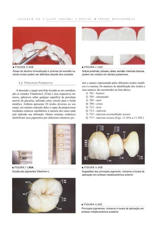 S E L E Ç Ã O   DE   C O R   E   A J U S T E   F U N C I O N A L   E   E S T É T I C O   EM   P R Ó T E S E   M E T A L O C E R Â M I C A




■ FIGURA II.44B                                                                 ■ FIGURA I I.44C
Áreas de dentina mineralizada e prismas de esmalte na                           Sulcos proximais, oclusais, cáries, esmalte, manchas brancas,
borda incisai podem ser definidos através dos corantes.                         podem ser criados em dentes posteriores.


     4.2. PRINCIPAIS PIGMENTOS                                                  rém a nuance representada pelos diferentes óxidos metáli-
                                                                                cos é a mesma. Os números de identificação dos óxidos e
    A descrição a seguir será feita levando-se em considera-                    suas nuances são encontrados na lista abaixo.
ção os corantes Vitachrom-L (Vita) e seus respectivos nú-                          1) 701 - branco
meros, aplicáveis sobre qualquer superfície de porcelana                           2) 703 - alaranjado
através da glicerina, utilizada como veículo para o óxido                          3) 705 - azul
metálico. Embora apresente 20 óxidos diversos no seu                               4) 708 - cinza
estojo, um número reduzido deles é capaz de proporcionar                           5) 712 - ocre
resultados estéticos satisfatórios à maioria dos casos onde                        6) 713 - marrom
está indicada sua utilização. Outros sistemas cerâmicos                            7) 715 - marrom avermelhado escuro
identificam seus pigmentos por diferentes números, po-                             8) 717 - marrom escuro (Figs. 11.45A a 11.45C)




■ FIGURA I 1,45A                                                                ■ FIGURA II.45B
Escala dos pigmentos Vitachrom L                                                Sugestões dos principais pigmento, números e locais de
                                                                                aplicação em prótese metalocerâmica anterior




                                                                                ■ FIGURA II.45C
                                                                                Principais pigmentos, números e locais de aplicação em
                                                                                prótese metalocerâmica posterior
 