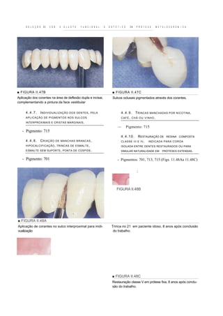 S E L E Ç Ã O   DE   C O R     E   A J U S T E   F U N C I O N A L   E   E S T É T I C O     EM   P R Ó T E S E   M E T A L O C E R Â M I C A




■ FIGURA II.47B                                                                  ■ FIGURA II.47C
Aplicação dos corantes na área de deflexão dupla e incisai,                      Sulcos oclusais pigmentados através dos corantes.
complementando a pintura da face vestibular


     4.4.7.      I NDIVIDUALIZAÇÃO          DOS DENTES , PELA                            4 . 4 . 9 . T RINCAS MANCHADAS           POR NICOTINA ,
     APLICAÇÃO DE PIGMENTOS NOS SULCOS                                                   CAFÉ, CHÁ OU VINHO.
     INTERPROXIMAIS E CRISTAS MARGINAIS .
                                                                                      —         Pigmento: 715
   - Pigmento: 715
                                                                                         4.4.10.           RESTAURAÇÃO DE       RESINA COMPOSTA
     4.4.8.      C RIAÇÃO         DE MANCHAS BRANCAS ,                                   CLASSE III E IV ,       INDICADA PARA COROA
     HIPOCALCIFICAÇÃO , TRINCAS DE ESMALTE ,                                             ISOLADA ENTRE DENTES RESTAURADOS OU PARA
     ESMALTE SEM SUPORTE , PONTA DE CÚSPIDE .                                            SIMULAR NATURALIDADE EM            PRÓTESES EXTENSAS.


   - Pigmento: 701                                                                    - Pigmentos: 701, 713, 715 (Figs. 11.48Aa 11.48C)


                                                                                                       :



                                                                                     FIGURA II.48B




■ FIGURA II.48A
Aplicação de corantes no sulco interproximal para inidi-                        Trinca no 21 em paciente idoso, 8 anos após conclusão
vualização                                                                       do trabalho.




                                                                                ■ FIGURA II.48C
                                                                                 Restauração classe V em prótese fixa, 8 anos após conclu-
                                                                                 são do trabalho.
 