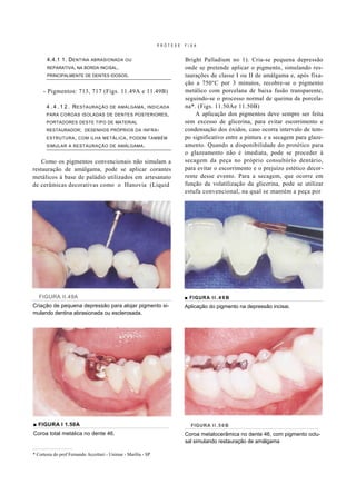 PRÓTESE   FIXA


       4.4.1 1. D ENTINA ABRASIONADA           OU                         Bright Palladium no 1). Cria-se pequena depressão
       REPARATIVA, NA BORDA INCISAL,                                      onde se pretende aplicar o pigmento, simulando res-
       PRINCIPALMENTE DE DENTES IDOSOS.                                   taurações de classe I ou II de amálgama e, após fixa-
                                                                          ção a 750°C por 3 minutos, recobre-se o pigmento
     - Pigmentos: 713, 717 (Figs. 11.49A e 11.49B)                        metálico com porcelana de baixa fusão transparente,
                                                                          seguindo-se o processo normal de queima da porcela-
       4 . 4 . 1 2 . R ESTAURAÇÃO       DE AMÁLGAMA , INDICADA            na*. (Figs. 11.50Ae 11.50B)
       PARA COROAS ISOLADAS DE DENTES POSTERIORES ,                           A aplicação dos pigmentos deve sempre ser feita
       PORTADORES DESTE TIPO DE MATERIAL                                  sem excesso de glicerina, para evitar escorrimento e
       RESTAURADOR ; DESENHOS PRÓPRIOS DA INFRA -                         condensação dos óxidos, caso ocorra intervalo de tem-
       ESTRUTURA , COM ILHA METÁLICA , PODEM TAMBÉM                       po significativo entre a pintura e a secagem para glaze-
       SIMULAR A RESTAURAÇÃO DE AMÁLGAMA .                                amento. Quando a disponibilidade do protético para
                                                                          o glazeamento não é imediata, pode se proceder à
    Como os pigmentos convencionais não simulam a                         secagem da peça no próprio consultório dentário,
restauração de amálgama, pode se aplicar corantes                         para evitar o escorrimento e o prejuízo estético decor-
metálicos à base de paládio utilizados em artesanato                      rente desse evento. Para a secagem, que ocorre em
de cerâmicas decorativas como o Hanovia (Liquid                           função da volatilização da glicerina, pode se utilizar
                                                                          estufa convencional, na qual se mantém a peça por




   FIGURA II.49A                                                          ■ FIGURA I I . 4 9 B
Criação de pequena depressão para alojar pigmento si-                     Aplicação do pigmento na depressão incisai.
mulando dentina abrasionada ou esclerosada.




■ FIGURA I 1.50A                                                            FIGURA I I . 5 0 B
Coroa total metálica no dente 46.                                         Coroa metalocerâmica no dente 46, com pigmento oclu-
                                                                          sal simulando restauração de amálgama

* Cortesia do prof Fernando Accetturi - Unimar - Marília - SP
 