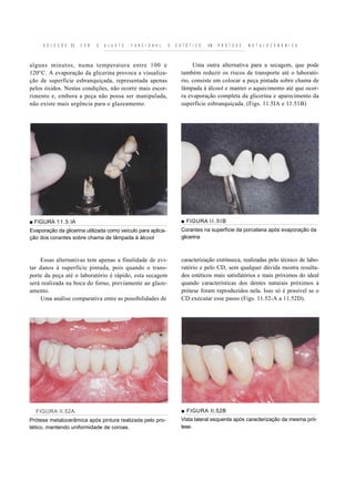 S E L E Ç Ã O   DE   C O R   E   A J U S T E   F U N C I O N A L   E   E S T É T I C O   EM   P R Ó T E S E   M E T A L O C E R Â M I C A



alguns minutos, numa temperatura entre 100 e                                        Uma outra alternativa para a secagem, que pode
120°C. A evaporação da glicerina provoca a visualiza-                          também reduzir os riscos de transporte até o laborató-
ção de superfície esbranquiçada, representada apenas                           rio, consiste em colocar a peça pintada sobre chama de
pelos óxidos. Nestas condições, não ocorre mais escor-                         lâmpada à álcool e manter o aquecimento até que ocor-
rimento e, embora a peça não possa ser manipulada,                             ra evaporação completa da glicerina e aparecimento da
não existe mais urgência para o glazeamento.                                   superfície esbranquiçada. (Figs. 11.5IA e 11.51B)




■ FIGURA 11.5 IA                                                               ■ FIGURA I I . 5 I B
Evaporação da glicerina utilizada como veículo para aplica-                    Corantes na superfície da porcelana após evaporação da
ção dos corantes sobre chama de lâmpada à álcool                               glicerina



    Essas alternativas tem apenas a finalidade de evi-                         caracterização extrínseca, realizadas pelo técnico de labo-
tar danos à superfície pintada, pois quando o trans-                           ratório e pelo CD, sem qualquer dúvida mostra resulta-
porte da peça até o laboratório é rápido, esta secagem                         dos estéticos mais satisfatórios e mais próximos do ideal
será realizada na boca do forno, previamente ao glaze-                         quando características dos dentes naturais próximos à
amento.                                                                        prótese foram reproduzidos nela. Isso só é possível se o
    Uma análise comparativa entre as possibilidades de                         CD executar esse passo (Figs. 11.52-A a 11.52D).




  FIGURA II.52A                                                                ■ FIGURA II.52B
Prótese metalocerâmica após pintura realizada pelo pro-                        Vista lateral esquerda após caracterização da mesma pró-
tético, mantendo uniformidade de coroas.                                       tese.
 