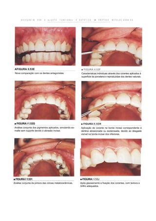 S E L E Ç Ã O   DE   C O R   E   A J U S T E   F U N C I O N A L   E   E S T É T I C O   EM   P R Ó T E S E   M E T A L O C E R Â M IC A




 AFIGURA II.53E                                                                 ■ FIGURA II.53F
 Nova comparação com os dentes antagonistas.                                    Características individuais através dos corantes aplicados à
                                                                                superficie da porcelana e reproduzidas dos dentes naturais.




■ FIGURA I 1.53G                                                                ■ FIGURA I I . 53H
Análise conjunta dos pigmentos aplicados, simulando es-                         Aplicação de corante na borda incisai correspondente à
malte sem suporte devido á abrasão incisai.                                     dentina abrasíonada ou esclerosada, devido ao desgaste
                                                                                visível na borda incisai dos inferiores.




■ FIGURA I 1.531                                                              ■ FIGURA I I.53J
Análise conjunta da pintura das coroas metalocerâmícas.                        Após glazeamento e fixação dos corantes, com textura e
                                                                               brilho adequados.
 