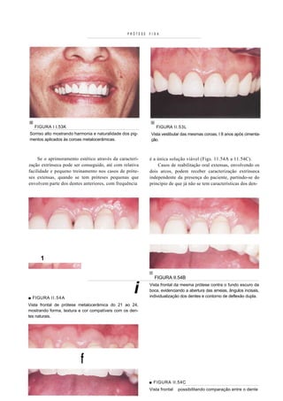 PRÓTESE   FIXA




   FIGURA I I.53K                                             FIGURA II.53L
Sorriso alto mostrando harmonia e naturalidade dos pig-    Vista vestibular das mesmas coroas, I 8 anos após cimenta-
mentos aplicados às coroas metalocerâmicas.                ção.



     Se o aprimoramento estético através da caracteri-     é a única solução viável (Figs. 11.54A a 11.54C).
zação extrínseca pode ser conseguido, até com relativa         Casos de reabilitação oral extensas, envolvendo os
facilidade e pequeno treinamento nos casos de próte-       dois arcos, podem receber caracterização extrínseca
ses extensas, quando se tem próteses pequenas que          independente da presença do paciente, partindo-se do
envolvem parte dos dentes anteriores, com frequência       princípio de que já não se tem características dos den-




      1


                                                             FIGURA II.54B



■ FIGURA I I . 5 4 A
                                                     i     Vista frontal da mesma prótese contra o fundo escuro da
                                                           boca, evidenciando a abertura das ameias, ângulos incisais,
                                                           individualização dos dentes e contorno de deflexão dupla.

Vista frontal de prótese metalocerâmica do 21 ao 24,
mostrando forma, textura e cor compatíveis com os den-
tes naturais.




                          f
                                                           ■ FIGURA II.54C
                                                           Vista frontal   possibilitando comparação entre o dente
 