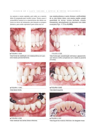 S E L E Ç Ã O   DE   C O R   E   A J U S T E   F U N C I O N A L   E   E S T É T I C O   EM   P R Ó T E S E   M E T A L O C E RÃ M I C A



tes naturais a serem copiadas, pois todos ou a maioria                         roas metalocerâmicas e assim eliminar a artificialidade
deles foi preparada para receber coroas. Nestes casos é                        de se criar dentes claros, com ameias amplas, grande
aconselhável anotar-se as características dos dentes na-                       quantidade de incisai, textura profunda, esmalte
turais no início do tratamento, previamente ao preparo                         transparente, principalmente em pacientes com idade
dentário, para então reproduzir parte delas nas co-                            avançada (Figs. 11.55Aa 11.55F).




                                                                                                                                                 ■>•




                                                                                                                                         *



■ FIGURA I I .55A                                                                   FIGURA II.55B
Vista frontal de reabilitação oral metalocerâmica em paci-                     Vista frontal após caracterização extrínseca e glazeamento,
ente tratado periodontalmente.                                                 com textura e brilho compatíveis com a idade do paciente
                                                                               (72 anos).




■ FIGURA I 1.55C                                                               ■ FIGURA II.55D
Vista lateral direita.                                                         Vista lateral esquerda.




■ FIGURA II.55E                                                                ■ FIGURA II.55F
Vista vestibular dos dentes ântero-inferiores.                                 Vista lingual dos incisivos inferiores e do desgaste incisai.
 
