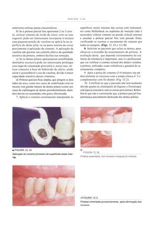PRÓTESE   FIXA



anteriores) utilizar pastas zincoenólicas;                      superfícies axiais internas das coroas com instrumen-
    b) Se a prótese parcial fixa apresentar 2 ou 3 coro         tos como Hollenback ou espátulas de inserção (não é
as, utilizar cimento de óxido de zinco, com ou sem              necessário colocar cimento na porção oclusal interna)
eugenol; pode ser interessante incorporar à mistura             e assentar a prótese parcial fixa com pressão firme,
uma pequena porção de vaselina ou aplicá-la na su               verificando se ocorreu o escoamento do cimento por
perfície do dente pilar ou na parte interna da coroa            todas as margens. (Figs. 12. IA e 12.1B)
previamente à aplicação do cimento. A aplicação da                  8. Solicitar ao paciente que oclua os dentes, para
vaselina não permite um controle efetivo da qualidade           observar a exatidão do assentamento de prótese. A
retentiva da prótese, embora facilite sua remoção;              avaliação deste, que depende extremamente do seu
    c) Se os dentes pilares apresentarem sensibilidade          limiar de tolerância é importante, mas é o profissional
dentinária excessiva pode ser interessante prolongar            que vai verificar o contato oclusal dos dentes vizinhos
essa etapa de cimentação provisória e, nesse caso, uti          à prótese, utilizados como referência e garantia de as
lizar cimentos à base de hidróxido de cálcio; ainda             sentamento completo;
assim é aconselhável o uso da vaselina, devido à maior              9. Após a presa do cimento (3-4 minutos em mé
capacidade retentiva desses cimentos;                           dia) eliminar os excessos com a sonda clínica n 2 5 e
                                                                                                                 P   P




    d) Próteses parciais fixas amplas, que atingem os dois      complementar com fio dental. (Fig. 12.2)
lados do arco, como nos casos de reabilitação oral ou               10. Certificar-se que o paciente não tem nenhuma
mesmo com grande número de dentes pilares (como nos             dúvida quanto às orientações de higiene e fisioterapia
casos de esplintagem de dentes periodontalmente abala           oral (que já executava com as coroas provisórias). Relem
dos) devem ser assentadas com graxa siliconizada.               brá-lo que não é conveniente que a prótese parcial fixa
    7. Aplicar o cimento corretamente manipulado às             permaneça parcialmente deslocada dos dentes pilares;




■ FIGURA 12. IA
                                                                  FIGURA 12.1B
Aplicação do cimento provisório às superfícies axiais inter-
nas.                                                            Prótese assentada, com excesso marginal de cimento.




                                                                «FIGURA 12.2
                                                                Prótese cimentada provisoriamente, após eliminação dos
                                                                excessos.
 