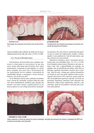 PRÓTESE   FIXA




  FIGURA I2.9A                                                 ■ FIGURA I2.9B
Eliminação dos excessos de cimento com sonda clínica           Complemento da remoção dos excessos de cimento com
n°5.                                                           auxilio de passa-fio e fio dental.



retornos periódicos para avaliação, de acordo com as neces-    aos pacientes. Por estes motivos, grande parte das próte-
sidades presumíveis de cada caso. (Figs. 12.10A e 12.10B)      ses que se soltam são simplesmente cortadas e refeitas,
                                                               quando à vezes poderiam ter vida útil muito maior, caso
      2 . 5 . FALHAS E RECIMENTAÇÃO                            não ocorresse esse inconveniente.
                                                                   Dispositivos mecânicos como o saca-pontes são uti-
    Extremamente desconcertante para qualquer pro-             lizados para essa finalidade (Figs. 12.1 IA e 12.11B).
tesista é a observação, às vezes precoce, de que uma           Com frequência dentes pilares fraturam-se sob esses es-
coroa, fixada sobre dente pilar de prótese fixa, sofreu        forços, haja vista a impossibilidade de avaliação, em
deslocamento. Aumentam as preocupações se o dente              qualquer caso, do paralelismo dos pilares; além disso as
pilar é polpado, pois junto com o inconveniente do             pancadas significam desconforto razoável para o paci-
seu deslocamento ter-se-á também o desconforto da              ente. Além do mais, o tempo que a prótese permaneceu
sensibilidade durante a mastigação e trocas térmicas,          em função no meio oral, pode significar fonte de preo-
halitose e até recidiva de cárie.                              cupação adicional ao CD e paciente, porque pode ter
    Se há diferentes técnicas para confecção de próteses       sido acentuadamente aquém do esperado ou mesmo do
fixas e mesmo de cimentação, a prótese ainda não conta         prometido. Repetições significam custo adicional com
com meios absolutamente confiáveis para remoção das            laboratório, tempo clínico suplementar, material e, não
mesmas, sem danos maiores à própria prótese ou aos             raramente, ponto de discordância suficiente para justi-
dentes suportes ou sem infligir desconforto acentuado          ficar ações judiciais.




  FIGURAS l 2 . I O A e I2.I0B
Vistas vestibular e oclusal da prótese fixa após cimentação, remoção dos excessos de cimento e instalação da PPR com
encaixes de precisão e semi-precisão.
 