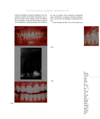 P A T O L O G I A S   O C L U S A I S   E   D I S F U N Ç Õ E S   C R A N I O M A N D I B U L A R E S



         rizada por alterações vasculares patológicas com con-                        de, sem, no entanto, haver aumento na magnitude
         sequente aumento de atividade osteoclástica nas re-                          dessa mobilidade ou qualquer alteração biológica.
         giões de pressão. Porém quando o dente se estabiliza                         Esse é um processo de adaptação à demanda funcio-
         na nova posição, ou seja, tais forças passam a não ser                       nal.
         mais traumáticas, o dente permanece com mobilida-                                O caso ilustrado nas fígs. 2.4A a 2.4E, mostra uma




                                                                                     G 2.4C




                                                                                                                                               ■
                                                                                                                                               FIGUR
                                                                                                                                               AS 2.4A
                                                                                                                                               a 2.4C
                                                                                                                                               (A/B)
                                                                                                                                               Vista
                                                                                       2.4D
                                                                                                                                               frontal
                                                                                                                                               do
                                                                                                                                               pacient
                                                                                                                                               e     em
                                                                                                                                               MIH e
                                                                                                                                               com a
                                                                                                                                               mandíb
                                                                                                                                               ula
                                                                                                                                               movime
                                                                                                                                               ntada
                                                                                                                                               para a
                                                                                                                                               posição
                                                                                                                                               parafun
G 2.4A                                                                                                                                         cional,
                                                                                                                                               causand
                                                                                                                                               o mobi-
                                                                                                                                               lidade e
                                                                                                                                               movime
                                                                                                                                               ntação
                                                                                                                                               dos
                                                                                                                                               dentes
 
