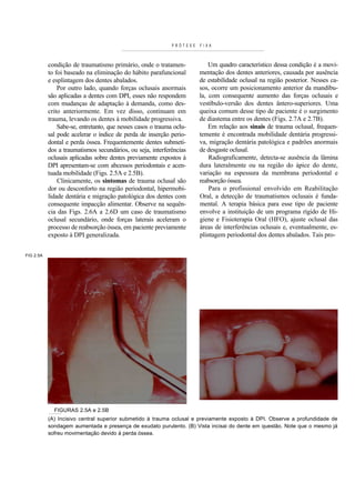 PRÓTESE   FIXA



           condição de traumatismo primário, onde o tratamen-              Um quadro característico dessa condição é a movi-
           to foi baseado na eliminação do hábito parafuncional        mentação dos dentes anteriores, causada por ausência
           e esplintagem dos dentes abalados.                          de estabilidade oclusal na região posterior. Nesses ca-
               Por outro lado, quando forças oclusais anormais         sos, ocorre um posicionamento anterior da mandíbu-
           são aplicadas a dentes com DPI, esses não respondem         la, com consequente aumento das forças oclusais e
           com mudanças de adaptação à demanda, como des-              vestíbulo-versão dos dentes ântero-superiores. Uma
           crito anteriormente. Em vez disso, continuam em             queixa comum desse tipo de paciente é o surgimento
           trauma, levando os dentes à mobilidade progressiva.         de diastema entre os dentes (Figs. 2.7A e 2.7B).
               Sabe-se, entretanto, que nesses casos o trauma oclu-        Em relação aos sinais de trauma oclusal, frequen-
           sal pode acelerar o índice de perda de inserção perio-      temente é encontrada mobilidade dentária progressi-
           dontal e perda óssea. Frequentemente dentes submeti-        va, migração dentária patológica e padrões anormais
           dos a traumatismos secundários, ou seja, interferências     de desgaste oclusal.
           oclusais aplicadas sobre dentes previamente expostos à          Radiograficamente, detecta-se ausência da lâmina
           DPI apresentam-se com abcessos periodontais e acen-         dura lateralmente ou na região do ápice do dente,
           tuada mobilidade (Figs. 2.5A e 2.5B).                       variação na espessura da membrana periodontal e
               Clinicamente, os sintomas de trauma oclusal são         reabsorção óssea.
           dor ou desconforto na região periodontal, hipermobi-            Para o profissional envolvido em Reabilitação
           lidade dentária e migração patológica dos dentes com        Oral, a detecção de traumatismos oclusais é funda-
           consequente impacção alimentar. Observe na sequên-          mental. A terapia básica para esse tipo de paciente
           cia das Figs. 2.6A a 2.6D um caso de traumatismo            envolve a instituição de um programa rígido de Hi-
           oclusal secundário, onde forças laterais aceleram o         giene e Fisioterapia Oral (HFO), ajuste oclusal das
           processo de reabsorção óssea, em paciente previamente       áreas de interferências oclusais e, eventualmente, es-
           exposto à DPI generalizada.                                 plintagem periodontal dos dentes abalados. Tais pro-


FIG 2.5A




             FIGURAS 2.5A e 2.5B
           (A) Incisivo central superior submetido à trauma oclusal e previamente exposto à DPI. Observe a profundidade de
           sondagem aumentada e presença de exudato purulento. (B) Vista incisai do dente em questão. Note que o mesmo já
           sofreu movimentação devido à perda óssea.
 