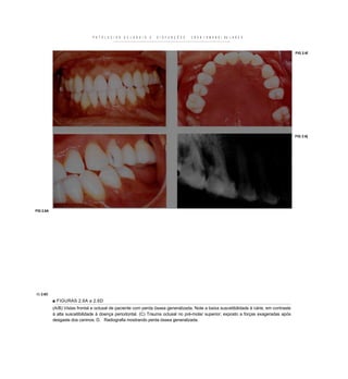 P A T O L O C I A S   O C L U S A I S   E   D I S F U N Ç Õ E S   C R A N I O M A N D I BU L A R E S



                                                                                                                                         FIG 2.6Í




                                                                                                                                         FIG 2.6[




FIG 2.6A




IG 2.6C
           ■ FIGURAS 2.6A a 2.6D
           (A/B) Vistas frontal e oclusal de paciente com perda óssea generalizada. Note a baixa suscetibilidade à cárie, em contraste
           à alta suscetibilidade à doença periodontal. (C) Trauma oclusal no pré-molar superior; exposto a forças exageradas após
           desgaste dos caninos. D. Radiografia mostrando perda óssea generalizada.
 