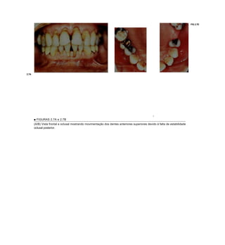FIG 2.7E




2.7A




                                                                                                  
       ■ FIGURAS 2.7A e 2.7B
       (A/B) Vista frontal e oclusal mostrando movimentação dos dentes anteriores superiores devido à falta de estabilidade
       oclusal posterior.
 