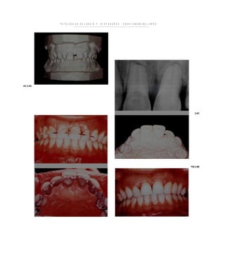 P A T O L O G I A S   O C L U S A I S   F   D I S F U N Ç Õ E S   C R A N I O M A N D I B U L A R E S




-IG 2.8A




                                                                                                                      2.8C




                                                                                                                   FIG 2.8E
 