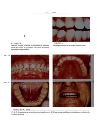 PRÓTESE    FIXA




                               1


             M FIGURA 2.9                                                     FIGURA 2.10
             Desgaste dentário localizado isoladamente no pré-molar         Desgaste patológico de canino em paciente jovem.
             devido à ausência de guia lateral pelo canino decorrente
             de mordida aberta anterior


FIG 2.1 IA




FIG2.IIC




             ■ FIGURAS 2.1 IA a 2.1 ID
             (A, B, C) Desgaste dental generalizado devido ao bruxismo. (D) Placa oclusal estabilizadora, utilizada com o objetivo de
             proteger os dentes.
 
