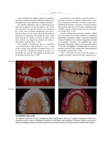 PRÓTESE   FIXA



                Após a obtenção dos modelos, passa-se à tomada do                    Previamente ao enceramento, o primeiro passo é a
            arco facial e registro da posição de Relação Cêntrica com a          confecção de alívios nas regiões interproximais e oclu-
            utilização do JIG, como descrito em capítulos anteriores.            sais, normalmente realizados com gesso e que, têm a
                Um detalhe importante está na determinação da                    finalidade de facilitar a inserção e remoção da placa
            espessura da placa já na fase de registro. Isso é feito              pelo paciente, além de evitar tensões exageradas sobre
            com auxílio do JIG, que deve permitir uma separação                  os dentes, queixa comum nos pacientes que usam pla-
            de ± 2mm, entre os dentes antagonistas mais próxi-                   cas oclusais (Fig. 2.14C).
            mos do contato oclusal. Apesar de muito discutida na                     Durante o enceramento, procura-se recobrir os dentes
            literatura, essa separação interoclusal de 2mm é sufi-               até o terço médio de suas faces vestibulares e entender-se
            ciente para prover rigidez à estrutura da placa, assim               ligeiramente em direção ao palato. A placa deve apresentar
            como realizar suas funções de proteção dos dentes e                  contatos simultâneos com os dentes antagonistas e durante
            relaxamento muscular (Fig. 2.14A).                                   os movimentos excursivos da mandíbula deve haver
                 Esse cuidado é fundamental, pois se a dimensão                  desoclusão lateral pelos caninos e protrusiva pelos dentes
            ^ertica tiansfoiàíi pai-à c> ■à-mcviWiOT tw^t   ÇJWS,   "=>« ■&-    ^!^tKn»^Ks,. Isso sJjgM&a. c^ue durante todos os movimentos
            terada ocorrerá uma diferença acentuada entre os ar-                 excursivos não deve haver contato entre dentes posteriores
            cos de abertura e fechamento presentes na boca e no                  e a superfície da placa (Fig. 2.14D).
            articulador que causará a necessidade de grandes ajus-                    C om a utilização de im ã na base do modelo, o
            tes da placa na boca (Fig. 2.14B)                                     mod elo encerado é separado do ramo superior do ar-


FIG 2.I4A




FIG 2.I4C




            ■ FIGURAS 2.l4Aa 2.I4D
            (A) Registro oclusal em RC para confecção de placa estabilizadora. Note que o registro é realizado na DVO que s
            pretende construir a placa. (B) Modelos montados em articulador semi-ajustável. (C) Modelo superior com alívios d
            gesso nas regiões proximais e oclusais, prévios ao enceramento da placa. (D) Vista oclusal do enceramento da placa.
 
