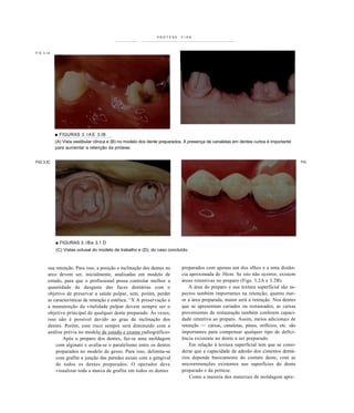 PRÓTESE      FIXA




FIG 3.IA




           ■ FIGURAS 3 . I A E 3.IB
           (A) Vista vestibular clínica e (B) no modelo dos dente preparados. A presença de canaletas em dentes curtos é importante
           para aumentar a retenção da prótese.


FIG 3.IC                                                                                                                              FIG




           ■ FIGURAS 3 . I B a 3.1 D
           (C) Vistas oclusal do modelo de trabalho e (D), do caso concluído.



      sua retenção. Para isso, a posição e inclinação dos dentes no        preparados com apenas um dos olhos e a uma distân-
      arco devem ser, inicialmente, analisadas em modelo de                cia aproximada de 30cm. Se isto não ocorrer, existem
      estudo, para que o profissional possa controlar melhor a             áreas retentivas no preparo (Figs. 3.2A e 3.2B).
      quantidade de desgaste das faces dentárias com o                         A área do preparo e sua textura superficial são as-
      objetivo de preservar a saúde pulpar, sem, porém, perder             pectos também importantes na retenção; quanto mai-
      as características de retenção e estética. ^X A preservação e        or a área preparada, maior será a retenção. Nos dentes
      a manutenção da vitalidade pulpar devem sempre ser o                 que se apresentam cariados ou restaurados, as caixas
      objetivo principal de qualquer dente preparado. Às vezes,            provenientes da restauração também conferem capaci-
      isso não é possível devido ao grau de inclinação dos                 dade retentiva ao preparo. Assim, meios adicionais de
      dentes. Porém, esse risco sempre será diminuído com a                retenção — caixas, canaletas, pinos, orifícios, etc. são
      análise prévia no modelo de estudo e exame radiográfico»             importantes para compensar qualquer tipo de defici-
              Após o preparo dos dentes, faz-se uma moldagem               ência existente no dente a ser preparado.
          com alginato e avalia-se o paralelismo entre os dentes               Em relação à textura superficial tem que se consi-
          preparados no modelo de gesso. Para isso, delimita-se            derar que a capacidade de adesão dos cimentos dentá-
          com grafite a junção das paredes axiais com a gengival           rios depende basicamente do contato deste, com as
          de todos os dentes preparados. O operador deve                   microrretenções existentes nas superfícies do dente
          visualizar toda a marca de grafite em todos os dentes            preparado e da prótese.
                                                                               Como a maioria dos materiais de moldagem apre-
 