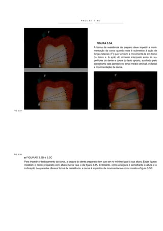 PRÓILSE     TIXA




                                                                             FIGURA 3.3A
                                                                           A forma de resistência do preparo deve impedir a movi-
                                                                           mentação da coroa quando esta é submetida à ação de
                                                                           forças laterais (F) que tendem a movimentá-la em torno
                                                                           do fulcro s. A ação do cimento interposto entre as su-
                                                                           perfícies do dente e coroa do lado oposto, auxiliada pelo
                                                                           paralelismo das paredes no terço médio-cervical, evitarão
                                                                           a movimentação da coroa.




FIG 3.3A




FIG 3.3B

           ■ FIGURAS 3.3B e 3.3C
           Para impedir o deslocamento da coroa, a largura do dente preparado tem que ser no mínimo igual à sua altura. Estas figuras
           mostram o dente preparado com altura menor que o da figura 3.3A. Entretanto, como a largura é semelhante à altura e a
           inclinação das paredes oferece forma de resistência, a coroa é impedida de movimentar-se como mostra a figura 3.3C.
 
