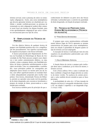 P R E P A R O S   DE   D E N T E S   C O M   F I N A L I D A D E   P R O T E T I C A



término cervical, como a presença de cáries ou restau-                          conhecimento do diâmetro ou parte ativa das brocas
rações subgengivais. Assim, uma coroa metaloplástica                            utilizadas é primordial para o controle da quantidade
que deveria apresentar término em chanfrado por ves-                            de dente desgastado, em função do preparo realizado.
tibular e metade vestíbulo-proximal, na presença de
restauração ou cárie subgengival, poderá obter somen-
te neste local um término em degrau biselado, para                                      VI - T ÉCNICA D E P R EPARO PA RA
evitar aprofundamento subgengival que seria o térmi-                                    C OROA M ETALOCERÂMICA (T ÉCNICA
no convencional para esse tipo de coroa.                                                DA SILHUETA )

                                                                                       A * PARA DENTES ANTERIORES
      V - SIMPLICIDADE                  DA     TÉCNICA           DE
      PREPARO                                                                      O preparo para coroa metalocerâmica utilizando
                                                                               metais básicos (ligas de Ni-Cr) apresenta as mesmas
    Um dos objetivo básicos de qualquer técnica de                             características do preparo para coroa metaloplástica,
preparo com finalidade protética deve ser a simplifica-                        tanto em relação à quantidade de desgaste quanto ao
ção dos procedimentos. Isto significa racionalização                           tipo de término cervical empregado.
da sequência de preparo e das brocas utilizadas.                                  A execução da técnica é realizada por meio de uma
    A técnica preconizada pelo Departamento de Pró-                            sequência de procedimentos padronizados que serão
tese da Faculdade de Odontologia de Bauru da Uni-                              descritos a seguir:
versidade de São Paulo procura cumprir esses objeti-
vos e tem caráter eminentemente didático, ou seja,                                      1 ) SULCO MARGINAL CERVICAL
orientar o aluno a preparar dentes com finalidade pro-
tética, de forma a preencher satisfatoriamente os prin-                           A função básica de iniciar o preparo pela confec-
cípios envolvidos. Uma vez compreendidos e assimila-                           ção deste sulco é estabelecer, já no início do mesmo, o
dos, esses princípios podem ser conseguidos por                                término cervical.
adaptações dessa técnica ou mesmo pelo uso de ou-                                 Com a broca esférica 1014, o sulco é realizado nas
tras, sem influir significativamente no resultado final:                       faces vestibular e lingual até chegar próximo ao conta-
o dente adequadamente preparado para receber uma                               to do dente vizinho. Na ausência de contato proxi-
prótese. Esta técnica, denominada Técnica da Silhue-                           mal, o sulco também deverá estender-se para as faces
ta, permite ao operador uma noção real da quantida-                            proximais.
de do dente desgastado, pois executa-se inicialmente o                            A profundidade do sulco de ± 0,7mm (metade do
preparo da metade do dente, preservando-se a outra                             diâmetro da broca) é conseguida introduzindo a broca
metade para avaliação.                                                         a 45° em relação à superfície a ser desgastada (Figs.
    Essa técnica também parte do princípio de que o                            3.15Aa3.15D).




  F IG UR AS 3 . l 5 A e 3 . I 5 B
Vistas vestibular (A) e palatina (B) do I 3 que irá receber preparo para coroa metalocerâmica.
 