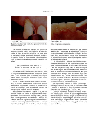 PRÓTESE   FIXA.




  FIGURA 3.I5C                                            ■ FIGURA 3.I5D
Sulco marginal cervical vestibular - posicionamento da    Sulco marginal cervical palatino.
broca esférica em 45 '

    Se o limite cervical do preparo for estender-se       desgastes desnecessários ou insuficientes que possam
subgengivalmente, o sulco marginal deve ser confecci-     por em risco a integridade do órgão pulpar e, ao mes-
onado ao nível da margem gengival. Por outro lado,        mo tempo, proporciona o desgaste ideal para acomo-
se a margem cervical do preparo apresentar indicação      dar o metal e porcelana. Os sulcos ficam delimitados
de término aquém do nível gengival, o sulco marginal      na área marginal cervical pelo desgaste prévio realiza-
deve ser localizado supragengivalmente e no nível de-     do com a broca esférica.
sejado.                                                       Os sulcos incisais, também em número de dois,
                                                          seguem a mesma direção dos sulcos vestibulares e são
     2) SULCOS DE ORIENTAÇÃO: NAS FACES                   feitos com a mesma broca, inclinada aproximadamente
     VESTIBULAR, INCISAL E LINCUO-CERVICAL                a 45° em relação ao longo eixo do dente e dirigida
                                                          para a face lingual nos dentes superiores e para vesti-
    As coroas metalocerâmicas necessitam de 1.5mm         bular no preparo de dentes ântero-inferiores. Sua pro-
de desgaste nas faces vestibular e metade das proxi-      fundidade deve ficar por volta de 2,0mm, o que cor-
mais e 2mm na incisai, para acomodar o metal e por-       responde a uma vez e meia o diâmetro da broca. Esse
celana dentro do contorno anatómico normal que o          desgaste possibilita a obtenção de resultados estéticos
dente apresentava.                                        satisfatórios para a porcelana, permitindo a transluci-
    Assim, a melhor maneira para controlar a quanti-      dez característica do esmalte nesse local.
dade de desgaste, em função das necessidades estéticas        Na região línguo-cervical, os sulcos deverão apre-
e mecânicas do preparo, é através da confecção de         sentar profundidade de ± 0,6mm, o que corresponde
sulcos de orientação, que inicialmente, deverão ser       à metade do diâmetro da broca e permite espessura
realizados em uma das metades do dente.                   suficiente para o metal.(Figs. 3.16A a 3.16E)
    Inicialmente, com a broca 3216 ou 2215, em alta           Os sulcos vestibulares e linguais devem ser orienta-
rotação, faz-se dois sulcos na face vestibular corres-    dos, tomando-se o cuidado de verificar previamente
pondentes ao diâmetro da broca (l,2mm), um no             em um modelo de estudo a relação de inclinação dos
meio e outro próximo à face proximal. Os sulcos de-       dentes envolvidos na prótese para que esses sulcos te-
vem ser realizados seguindo os planos inclinados des-     nham uma relação de paralelismo. Para a confecção
sas faces, um correspondente ao terço médio-cervical      destes em dentes com coroas curtas, pode-se utilizar a
e o outro, ao terço médio-incisal. Assim, evitam-se       broca n° 2215.
 