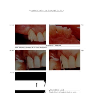 PREPAROS      DE   DENTES     COM     FINALIDADE     PROTÉTICA




FIG 3.I6A                                                                                                                         FIG 3.




                                                                        H FIGURAS 3.16A e 3.I6B
            Vistas vestibular (A) e palatina (B) dos sulcos de orientação.

FIG 3.I6C                                                                                                                         FIG 3.




FIG 3.I6E




                                                   r                1
                                                   i                i
                                                                             ■ FIGURAS 3.I6C a 3.I6E
                                                                    J         Relação diâmetro da boca/profundidade dos sulcos.
 