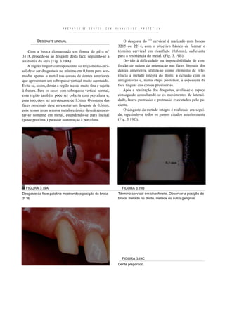 P R E P A R O S   DE   D E N T E S   C O M   F I N A L I D A D E   P R O T É T I C A



          DESGASTE LINCUAL                                                     O desgaste do 1/3 cervical é realizado com brocas
                                                                           3215 ou 2214, com o objetivo básico de formar o
    Com a broca diamantada em forma de pêra n°                             término cervical em chanfrete (0,6mm), suficiente
3118, procede-se ao desgaste desta face, seguindo-se a                     para a resistência do metal. (Fig. 3.19B)
anatomia da área (Fig. 3.19A).                                                 Devido à dificuldade ou impossibilidade de con-
    A região lingual correspondente ao terço médio-inci-                   fecção de sulcos de orientação nas faces linguais dos
sal deve ser desgastada no mínimo em 0,6mm para aco-                       dentes anteriores, utiliza-se como elemento de refe-
modar apenas o metal nas coroas de dentes anteriores                       rência a metade íntegra do dente, a oclusão com os
que apresentam um sobrepasse vertical muito acentuado.                     antagonistas e, numa etapa posterior, a espessura da
Evita-se, assim, deixar a região incisai muito fina e sujeita              face lingual das coroas provisórias.
à fratura. Para os casos com sobrepasse vertical normal,                      Após a realização dos desgastes, avalia-se o espaço
essa região também pode ser coberta com porcelana e,                       conseguido consultando-se os movimentos de laterali-
para isso, deve ter um desgaste de 1.3mm. O restante das                   dade, latero-protrusão e protrusão executados pelo pa-
faces proximais deve apresentar um desgaste de 0,6mm,                      ciente.
pois nessas áreas a coroa metalocerâmica deverá apresen-                       O desgaste da metade íntegra é realizado era segui-
tar-se somente em metal, estendendo-se para incisai                        da, repetindo-se todos os passos citados anteriormente
(poste próxima!) para dar sustentação à porcelana.                         (Fig. 3.19C).




  FIGURA 3.I9A                                                                FIGURA 3.I9B
Desgaste da face palatina mostrando a posição da broca                     Término cervical em chanferete. Observar a posição da
31 18.                                                                     broca: metade no dente, metade no sulco gengival.




                                                                              FIGURA 3.I9C
                                                                           Dente preparado.
 