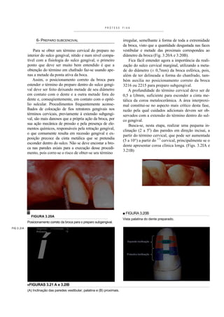 PRÓTESE      FIXA



                  6- PREPARO SUBCENCIVAL                                       irregular, semelhante à forma de toda a extremidade
                                                                               da broca, visto que a quantidade desgastada nas faces
                Para se obter um término cervical do preparo no                vestibular e metade das proximais correspondeu ao
            interior do sulco gengival, nítido e num nível compa-              diâmetro da broca (Fig. 3.20A e 3.20B).
            tível com a fisiologia do sulco gengival, o primeiro                   Fica fácil entender agora a importância da reali-
            ponto que deve ser muito bem entendido é que a                     zação do sulco cervical marginal, utilizando a meta-
            obtenção do término em chafrado faz-se usando ape-                 de do diâmetro (± 0,7mm) da broca esférica, pois,
            nas a metade da ponta ativa da boca.                               além de ter delineada a forma do chanfrado, tam-
               Assim, o posicionamento correto da broca para                   bém auxilia no posicionamento correto da broca
            estender o término do preparo dentro do sulco gengi-               3216 ou 2215 para preparo subgengival.
            val deve ser feito deixando metade de seu diâmetro                     A profundidade do término cervical deve ser de
            em contato com o dente e a outra metade fora do                    0,5 a l,0mm, suficiente para esconder a cinta me-
            dente e, conseqiientemente, em contato com o epité-                tálica da coroa metalocerâmica. A área interproxi-
            lio sulcular. Procedimentos frequentemente aconse-                 mal constitui-se no aspecto mais crítico desta fase,
            lhados de colocação de fios retratores gengivais nos               razão pela qual cuidados adicionais devem ser ob-
            términos cervicais, previamente à extensão subgengi-               servados com a extensão do término dentro do sul-
            val, são mais danosos que a própria ação da broca, por             co gengival.
            sua ação mecânica de pressão e pela presença de ele-                   Busca-se, nesta etapa, realizar uma pequena in-
            mentos químicos, responsáveis pela retração gengival,              clinação (2 a 5o) das paredes em direção incisai, a
            o que comumente resulta em recessão gengival e ex-
                                                                               partir do término cervical, que pode ser aumentada
            posição precoce da cinta metálica que se pretendia
                                                                               (5 a 10°) a partir do 1/3 cervical, principalmente se o
            esconder dentro do sulco. Não se deve encostar a bro-
                                                                               dente apresentar coroa clínica longa. (Figs. 3.2IA e
            ca nas paredes axiais para a execução desse procedi-
                                                                               3.21B)
            mento, pois corre-se o risco de obter-se ura término




                                                                               ■ FIGURA 3.20B
              FIGURA 3.20A
                                                                               Vista palatina do dente preparado.
            Posicionamento correto da broca para o preparo subgengival.
FIG 3.2IA         Segunda    J inclinação "S
                  Primeira                ^f




                  í
            «FIGURAS 3.21 A e 3.2IB
            (A) Inclinação das paredes vestibular; palatina e (B) proximais.
 