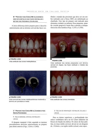 P R E P A R O S   DE   D E N T E S   C O M   F I N A L I D A D E   P R O T É T I C A



      B * P RE PARO PARA C OROA M ETALOCERÂMICA                           tibular e metade das proximais que deve ser em om-
      SEM CINTA METÁLICA NAS FACES VESTIBULAR E                           bro realizado com a broca 3069, em substituição ao
      METADE DAS PROXIMAIS (COLARLESS)                                    chanfrado. Este tipo de preparo está indicado para
                                                                          elementos isolados ou próteses fixas pequenas, quan-
   A única diferença deste preparo para o descrito                        do o tecido gengival é muito fino e permite a transpa-
anteriormente está no término cervical das faces ves-                     rência da cinta metálica (Figs. 3.25A a 3.25D).




■ FIGURA 3.25A
                                                                              FIGURA 3.25B
Vista vestibular das coroas metaloplásticas.
                                                                          Vista vestibular dos dentes preparados com término
                                                                          cervical em degrau nas faces vestibular e metade das
                                                                          proximais.




■ FIGURA 3.25C                                                            ■ FIGURA 3.25D
Vista cervical das coroas metalocerâmicas mostrando o                     Vista vestibular das coroas cimentadas.
término em porcelana e metal.




      C " PREPARO PARA COROA METALOCERÂMICA PARA                                  2 - SULCOS DE ORIENTAÇÃO: VESTIBULAR, OCLUSAL E
      DENTES POSTERIORES:                                                         LINCUAL


      1 - SULCO MARGINAL CERVICAL-VESTIBULAR E                                Para os dentes superiores, a profundidade dos
      LINCUAL
                                                                          sulcos vestibulares deve ser de l,2mm (diâmetro da
   O desgaste marginal é feito seguindo os mesmos                         broca) em função da estética. Os sulcos da face pala-
procedimentos descritos anteriormente no preparo                          tina, no terço médio cervical, devem ter um desgaste
para dente anterior (Figs. 3.26A a 3.26D).                                de ± 0,6mm e, na região médio oclusal, uma espes-
 