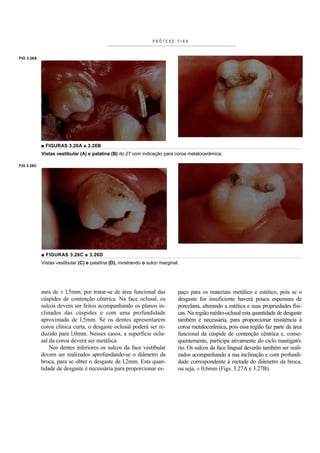 PRÓTESE FIXA


FIG 3.26A




            ■ FIGURAS 3.26A a 3.26B
            Vistas vestibular (A) e palatina (B) do 27 com indicação para coroa metalocerâmica.

FIG 3.26C




            ■ FIGURAS 3.26C e 3.26D
            Vistas vestibular (C) e palatina (D), mostrando o sulco marginal.




            sura de ± l,5mm, por tratar-se de área funcional das            paço para os materiais metálico e estético, pois se o
            cúspides de contenção cêntrica. Na face oclusal, os             desgaste for insuficiente haverá pouca espessura de
            sulcos devem ser feitos acompanhando os planos in-              porcelana, alterando a estética e suas propriedades físi-
            clinados das cúspides e com uma profundidade                    cas. Na região médio-oclusal esta quantidade de desgaste
            aproximada de l,5mm. Se os dentes apresentarem                  também é necessária, para proporcionar resistência à
            coroa clínica curta, o desgaste oclusal poderá ser re-          coroa metalocerâmica, pois essa região faz parte da área
            duzido para l,0mm. Nesses casos, a superfície oclu-             funcional da cúspide de contenção cêntrica e, conse-
            sal da coroa deverá ser metálica.                               quentemente, participa ativamente do ciclo mastigató-
                Nos dentes inferiores os sulcos da face vestibular          rio. Os sulcos da face lingual deverão também ser reali-
            devem ser realizados aprofundando-se o diâmetro da              zados acompanhando a sua inclinação e com profundi-
            broca, para se obter o desgaste de l,2mm. Esta quan-            dade correspondente à metade do diâmetro da broca,
            tidade de desgaste é necessária para proporcionar es-           ou seja, ± 0,6mm (Figs. 3.27A e 3.27B).
 