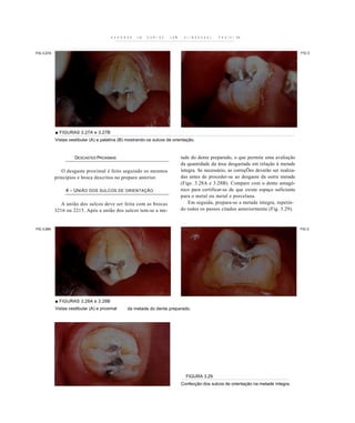 K b H A K U b   L)b   U b N I b b   L U M    b l I N A U U A U t   P K U l h l   HA




FIG 3.27A                                                                                                                                        FIG 3.




            ■ FIGURAS 3.27A e 3.27B
            Vistas vestibular (A) e palatina (B) mostrando os sulcos de orientação.


                      DESCASTES PROXIMAIS                                            tade do dente preparado, o que permite uma avaliação
                                                                                     da quantidade da área desgastada em relação à metade
               O desgaste proximal é feito seguindo os mesmos                        íntegra. Se necessário, as correçÕes deverão ser realiza-
            princípios e broca descritos no preparo anterior.                        das antes de proceder-se ao desgaste da outra metade
                                                                                     (Figs. 3.28A e 3.28B). Compare com o dente antagó-
                 4 - U NIÃO DOS SULCOS DE ORIENTAÇÃO                                 nico para certificar-se de que existe espaço suficiente
                                                                                     para o metal ou metal e porcelana.
               A união dos sulcos deve ser feita com as brocas                           Em seguida, prepara-se a metade íntegra, repetin-
            3216 ou 2215. Após a união dos sulcos tem-se a me-                       do todos os passos citados anteriormente (Fig. 3.29).


FIG 3.28A                                                                                                                                        FIG 3.




            ■ FIGURAS 3.28A e 3.28B
            Vistas vestibular (A) e proximal       da metade do dente preparado.




                                                                                       FIGURA 3.29
                                                                                     Confecção dos sulcos de orientação na metade íntegra.
 