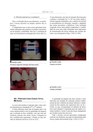 PRÓTESE   FIXA



      5 - PREPARO SUBCENCIVAL E ACABAMENTO                   5o para determinar uma área de retenção friccionai para
                                                             a prótese e inclinação de 5 a 10° nos terços médio e
    Para a realização desses procedimentos, os princí-       oclusal (segunda inclinação), com o objetivo de facilitar
pios e brocas descritos no preparo anterior são os           os procedimentos de colocação, remoção e adaptação
mesmos.                                                      das coroas provisórias e definitivas. Uma inclinação
    É indispensável que as faces axiais apresentem incli-    exagerada nessas áreas poderá comprometer a estabili-
nações adequadas para propiciar ao preparo característi-     dade da coroa, pois serão eliminadas áreas importantes
cas de retenção e estabilidade. Para isso, a inclinação do   de neutralização das forças oblíquas que incidem du-
terço cervical (primeira inclinação) deve ficar entre 2 a    rante o ato mastigatório (Figs. 3.30A a 3.30C).




 FIGURA 3.3OA                                                ■ FIGURA 3.3OB
Primeira e segunda inclinação das faces axiais.              Preparo concluído.




                                                             ■ FIGURA 3.3OC
                                                             Prótese cimentada




     VII - PREPARO PARA COROA TOTAL                              A quantidade de desgaste das faces oclusais e áreas
     METÁLICA                                                funcionais das cúspides de contenção cêntrica (médio-
                                                             oclusal da face vestibular dos dentes inferiores e médio-
    A coroa total metálica é indicada onde o fator esté-     oclusal da face palatina dos superiores) deve ser de ±
tico não precisa ser considerado (2OS e 3OS molares).        l,2mm, ou seja, correspondente ao diâmetro da broca.
    A única diferença deste tipo de preparo para o de        Esse maior desgaste é importante para dar rigidez à es-
coroa metalocerâmica está na quantidade de desgaste          trutura metálica e resistir à ação das forças mastigatórias
que é realizado na face vestibular, visto que esta será      que incidem nessas faces da coroa.
recoberta somente com metal. Assim, o desgaste na                Todo o término cervical apresentará configuração
face vestibular deve apresentar ± 0,6mm, ou seja, me-        uniforme em chanferete, que pode ser determinado pelas
tade do diâmetro da broca 3216 ou 2215.                      brocas citadas anteriormente (Figs. 3.3IA a 3.31C).
 