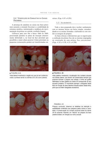 P R Ó T E S E   F I X A   A D E S I V A



     5 .4 * C ONFECÇÃO DE C ANALETAS OU C AIXAS                         caixas. (Figs. 4.1F e 4.2G)
     PROXIMAIS:
                                                                                5 . 5 ^ ACABAMENTO
    A presença de canaletas ou caixas nas faces proxi-
mais aumenta a retenção friccionai e a estabilidade da                      Toda a área preparada deve receber acabamento
estrutura metálica, minimizando a tendência de movi-                    com as mesmas brocas em baixa rotação, arrendon-
mentação da prótese no sentido vestíbulo-lingual.                       dando-se as arestas formadas e definindo-se com niti-
    Utiliza-se para esse fim a broca 1064 ou 3069,                      dez as margens do preparo.
posicionada paralela ao plano de inserção anterior-                         As fases clínicas e laboratoriais que se seguem para
mente delimitado e, no local da face proximal que                       a confecção da prótese fixa são as mesmas empregadas
possibilite a maior altura possível. Cáries proximais ou                na construção de uma prótese fixa convencional.
pequenas restaurações podem ser transformadas em                        ( Figs. 4.1G e 4.1H; 4.21 a 4.2M)




■ FIGURA 4.IA                                                           ■ FIGURA 4. IB
Vista lateral mostrando a região em que irá ser confeccio-              Vista palatina mostrando a localização dos contatos oclusais
nada a prótese tendo os dentes 23 e 25 como pilares.                    nos dentes pilares, que devem ser preservados sempre que
                                                                        possível durante o preparo dos dentes. A linha de grafite
                                                                        delimitada na fase palatina do dente 25 corresponde ao seu
                                                                        equador protético. É importante planejar o desgaste desta
                                                                        face em função da área retentiva situada abaixo desta linha,
                                                                        para que se evitem desgastes excessivos.




                                                                           FIGURA 4. IC
                                                                        Preparo concluído; observar os detalhes de retenção e
                                                                        estabilidade conferidos aos preparos pelos nichos e cana-
                                                                        letas. A preservação do contato proximal distai do dente
                                                                        25 foi possível, fazendo um "desvio" do preparo da face
                                                                        palatina-distal, em direção ao nicho oclusal.
 