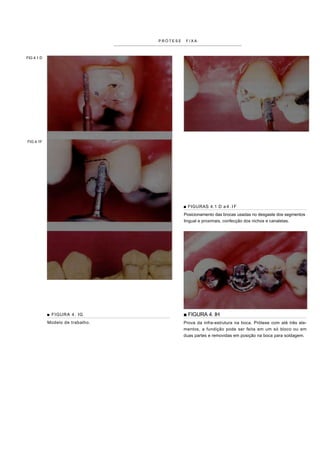 PRÓTESE    FIXA



FIG 4.1 D




FIG 4.1F




                                            ■ FIGURAS 4.1 D a 4 . I F
                                            Posicionamento das brocas usadas no desgaste dos segmentos
                                            lingual e proximais, confecção dos nichos e canaletas.




            ■ FIGURA 4. IG                  ■ FIGURA 4. IH
            Modelo de trabalho.             Prova da infra-estrutura na boca. Prótese com até três ele-
                                            mentos, a fundição pode ser feita em um só bloco ou em
                                            duas partes e removidas em posição na boca para soldagem.
 